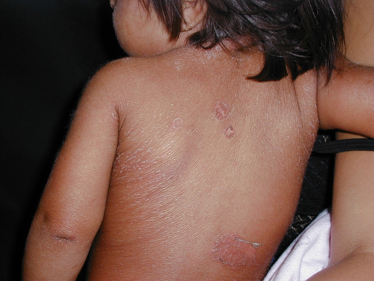 ENFERMEDAD DE RITTER