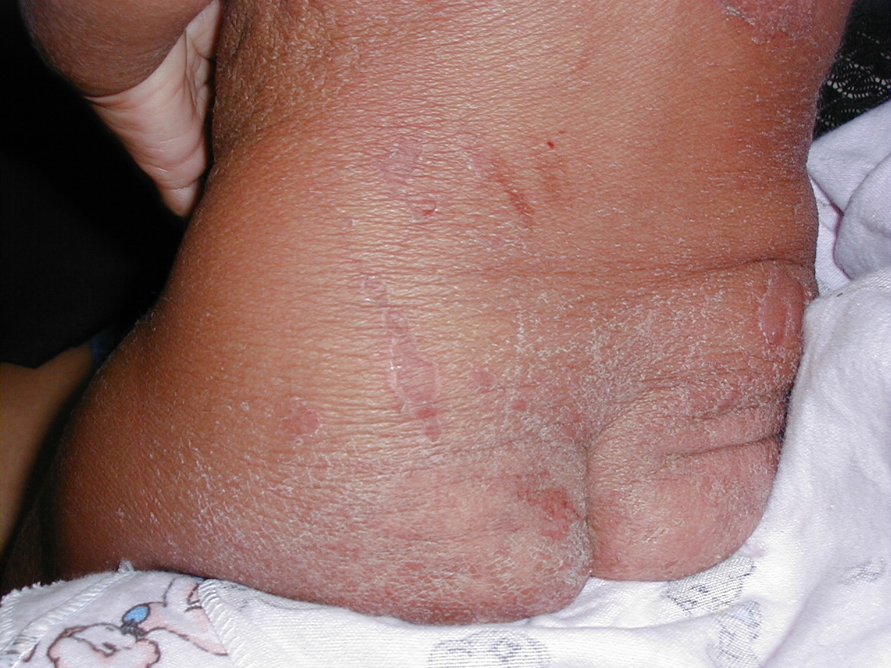 ENFERMEDAD DE RITTER