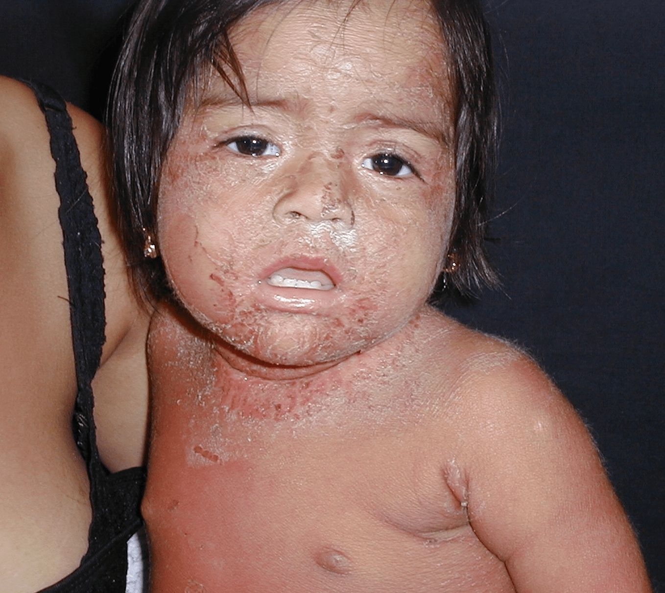 ENFERMEDAD DE RITTER