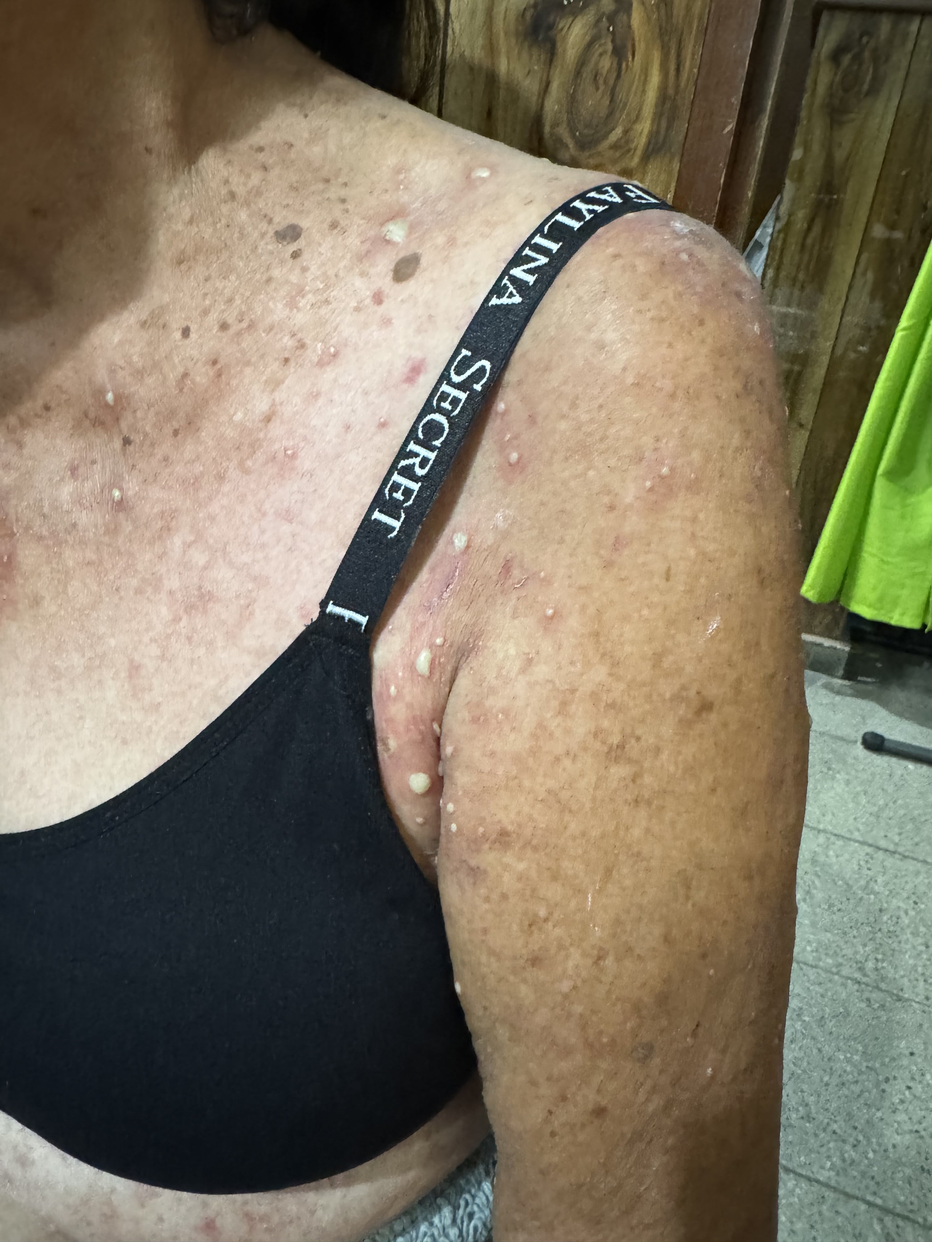 DERMATOSIS PUSTULOSA SUBCORNEA