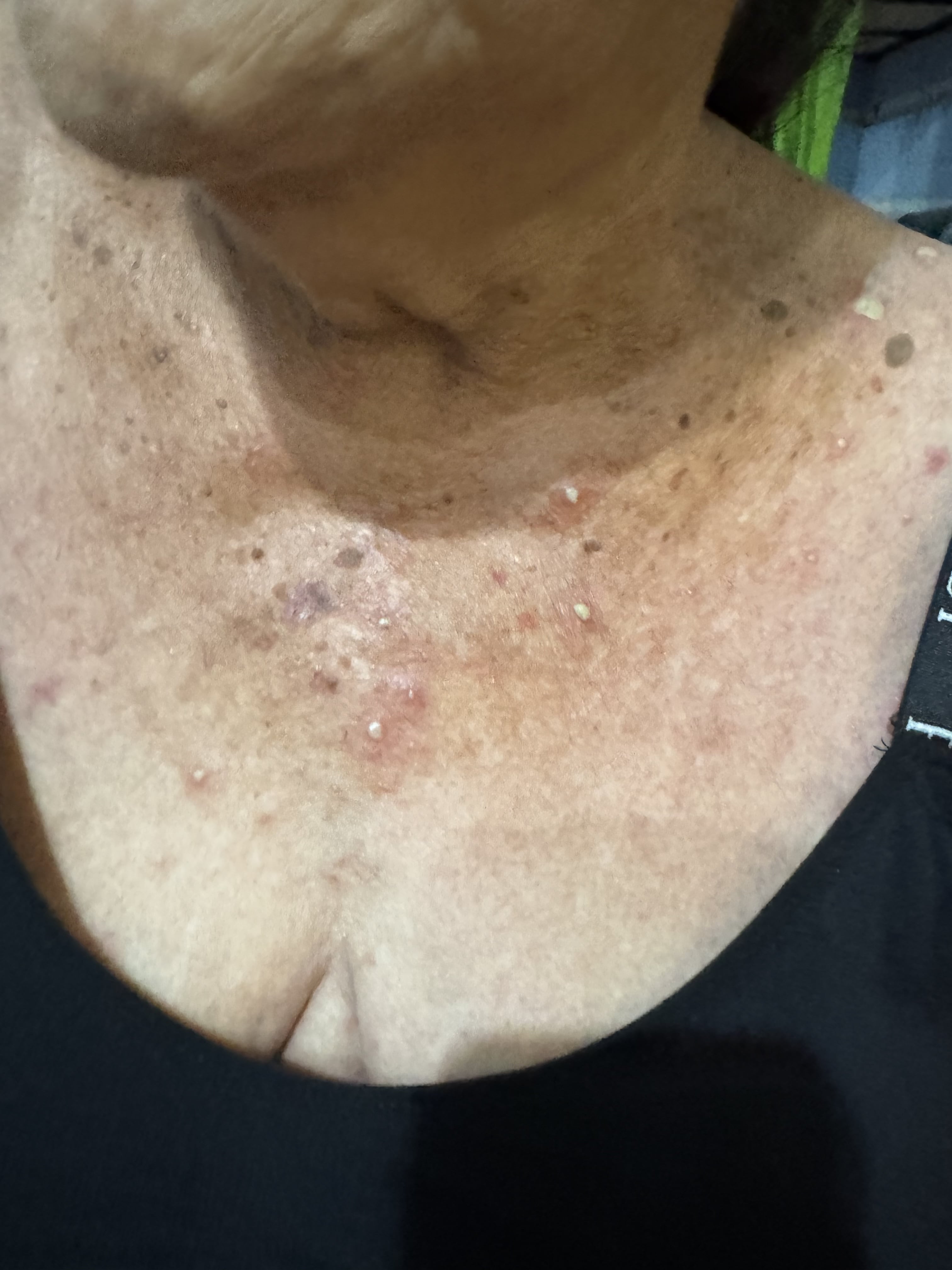 DERMATOSIS PUSTULOSA SUBCORNEA