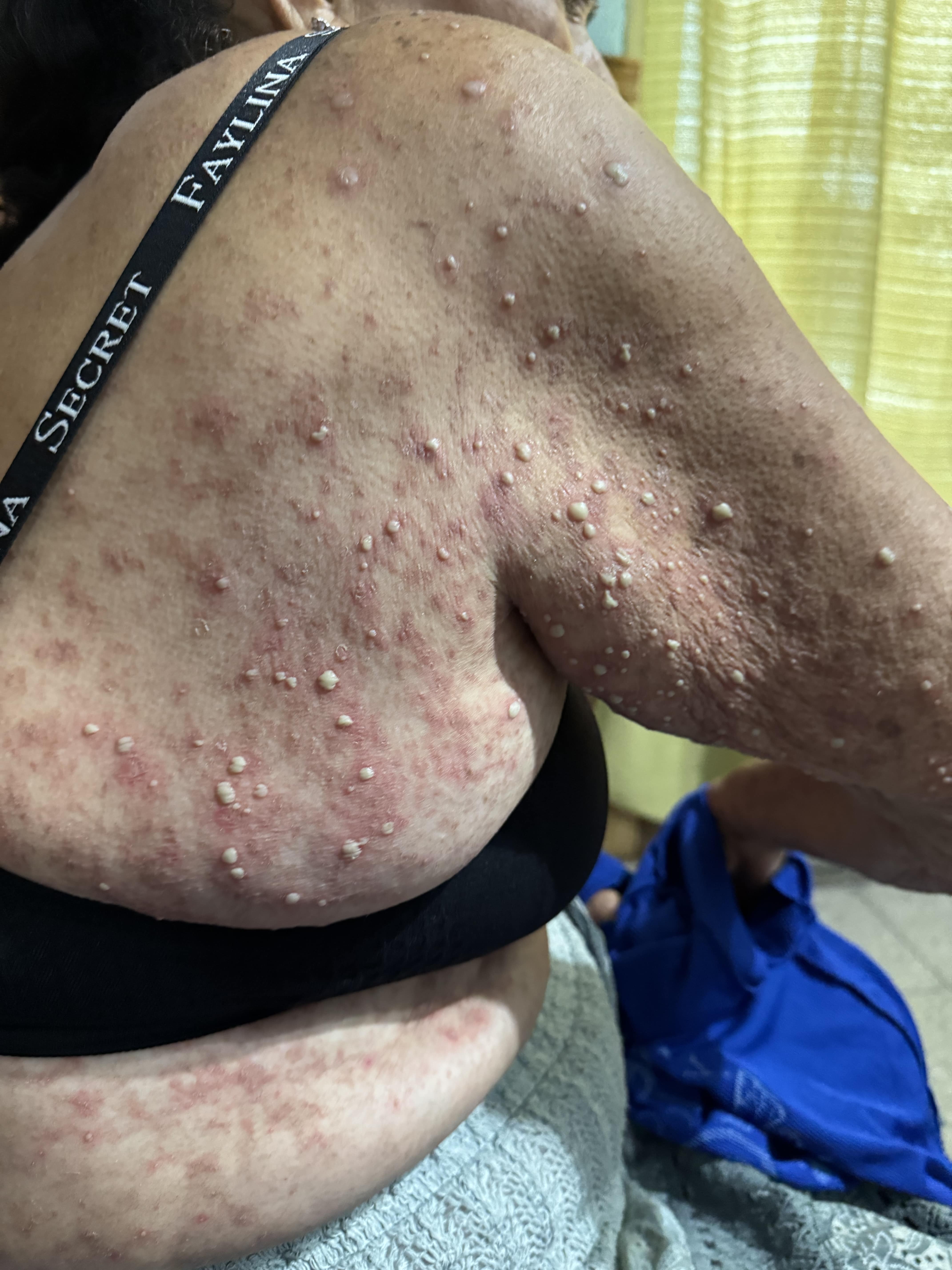 DERMATOSIS PUSTULOSA SUBCORNEA