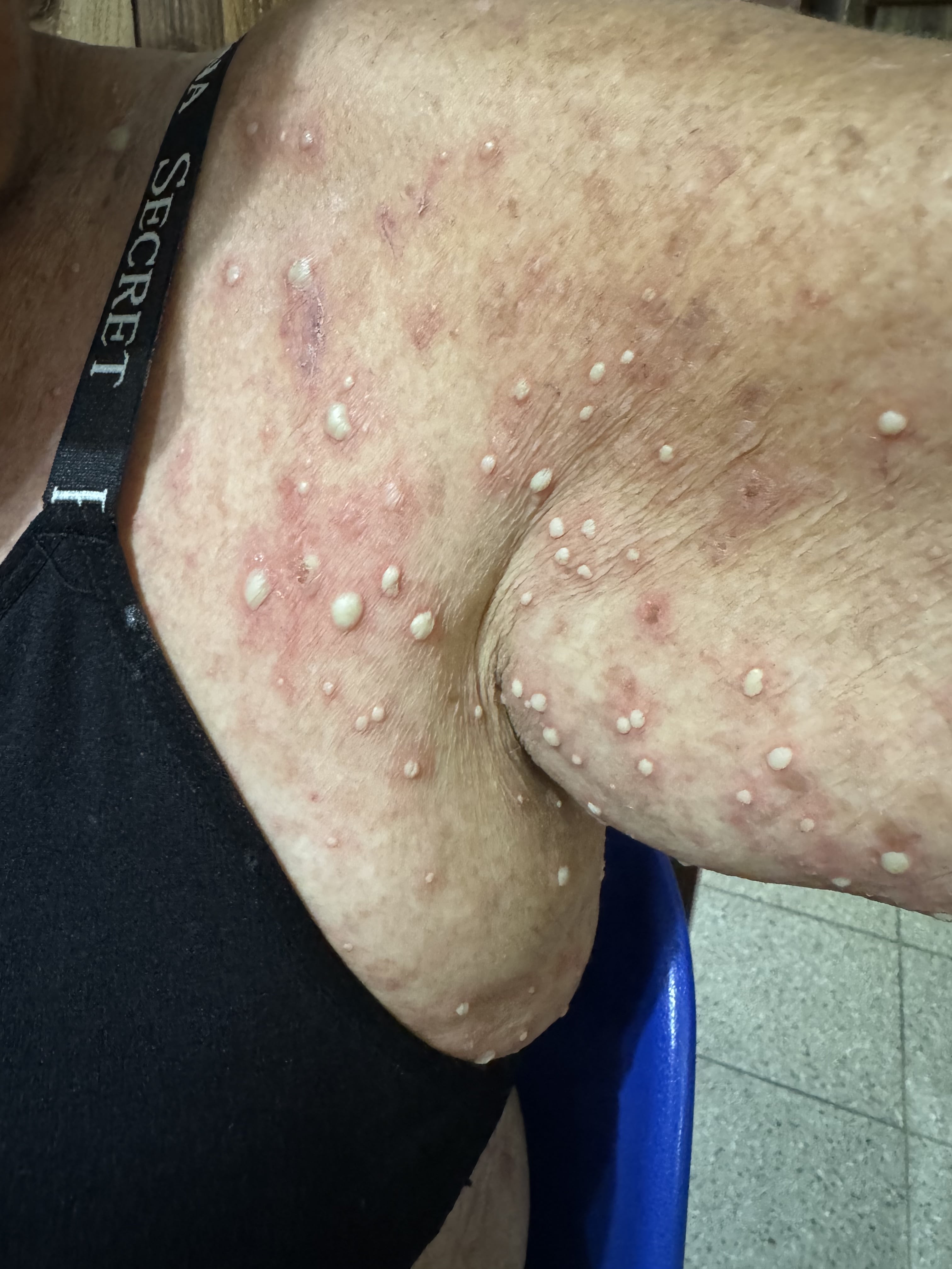 DERMATOSIS PUSTULOSA SUBCORNEA