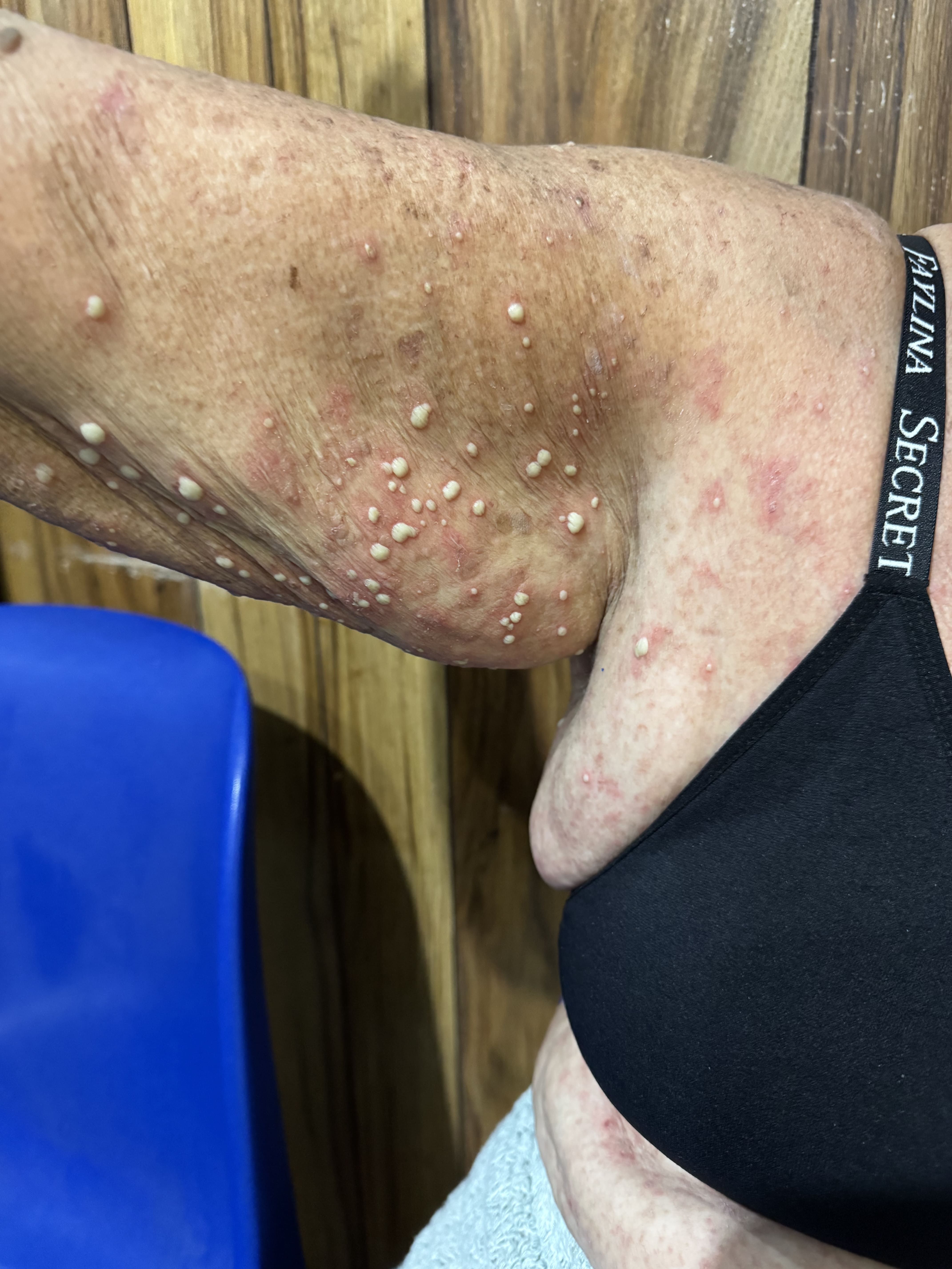 DERMATOSIS PUSTULOSA SUBCORNEA