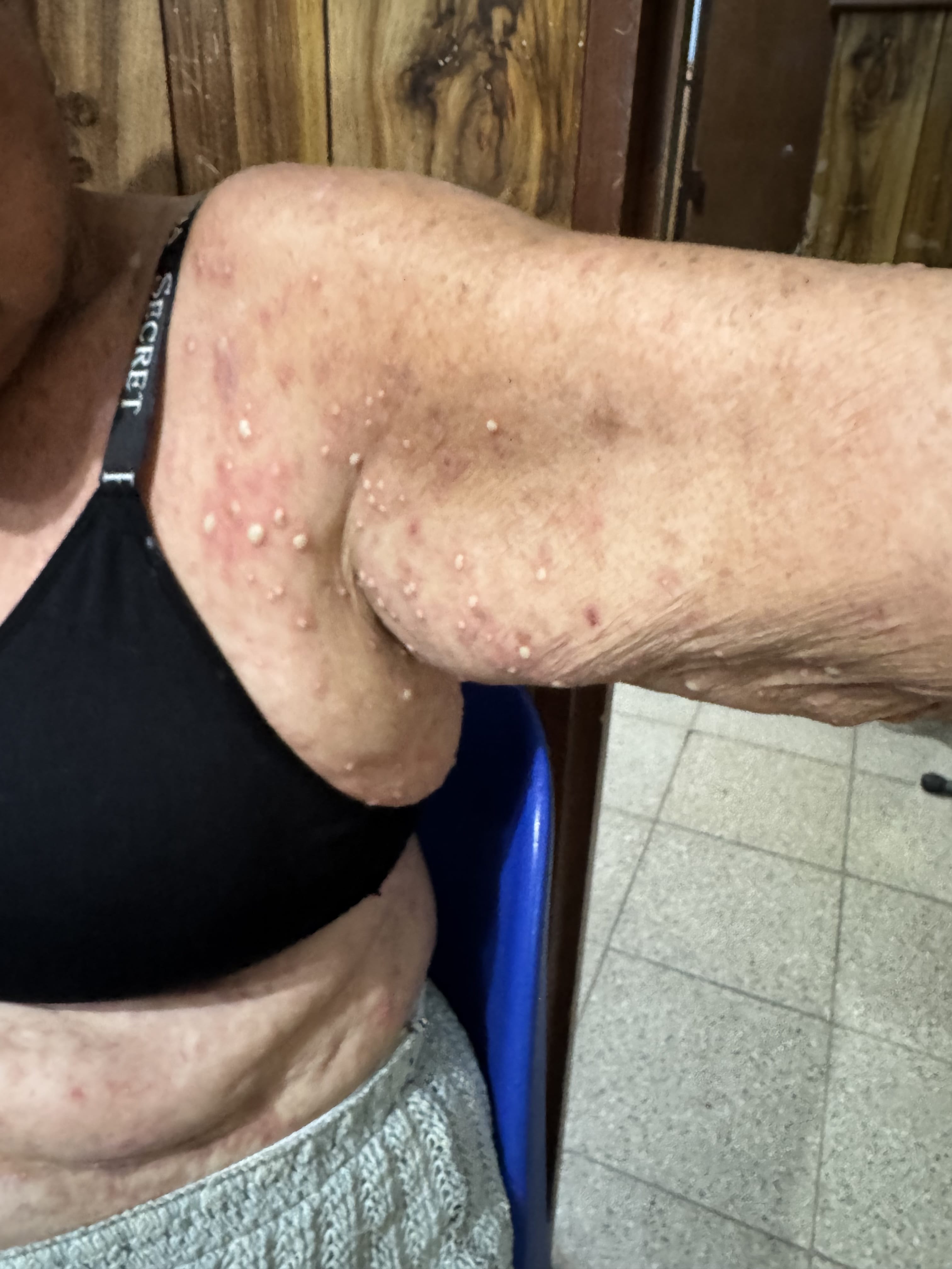 DERMATOSIS PUSTULOSA SUBCORNEA