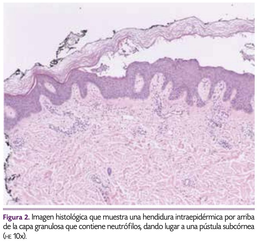DERRMATOSIS PUSTULOSA SUBCORNEA - Tomado de: DermatologíaCMQ2017;15(4):272-275