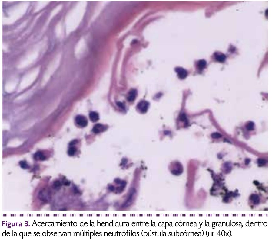 DERRMATOSIS PUSTULOSA SUBCORNEA - Tomado de: DermatologíaCMQ2017;15(4):272-275