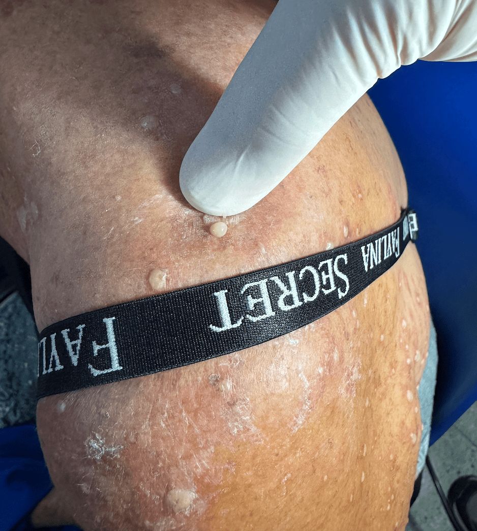 DERRMATOSIS PUSTULOSA SUBCORNEA