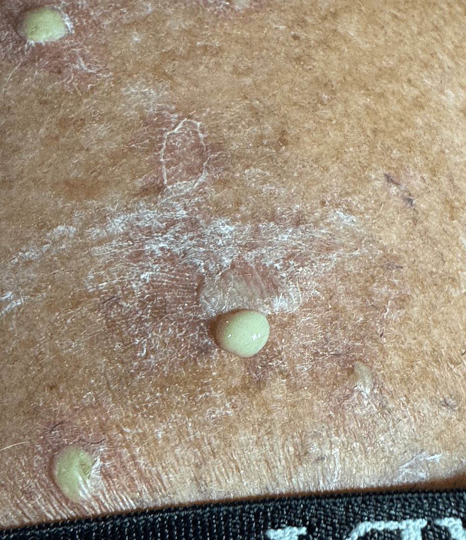 DERRMATOSIS PUSTULOSA SUBCORNEA