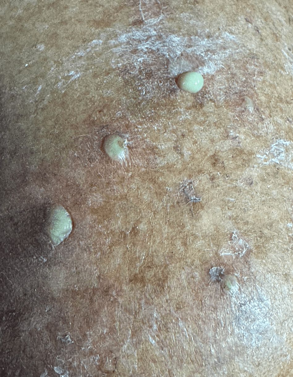 DERRMATOSIS PUSTULOSA SUBCORNEA