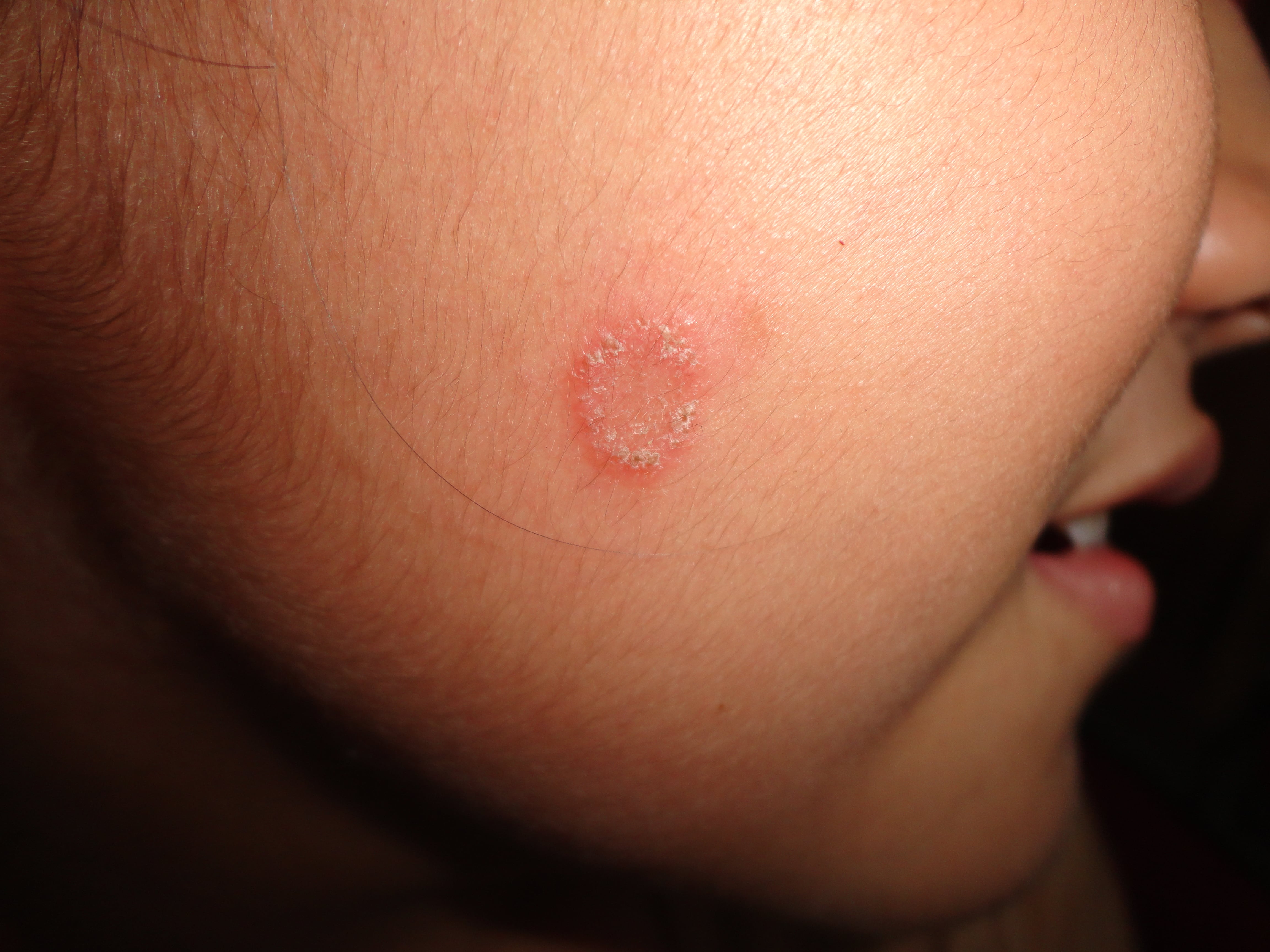 TINEA DE LA CARA