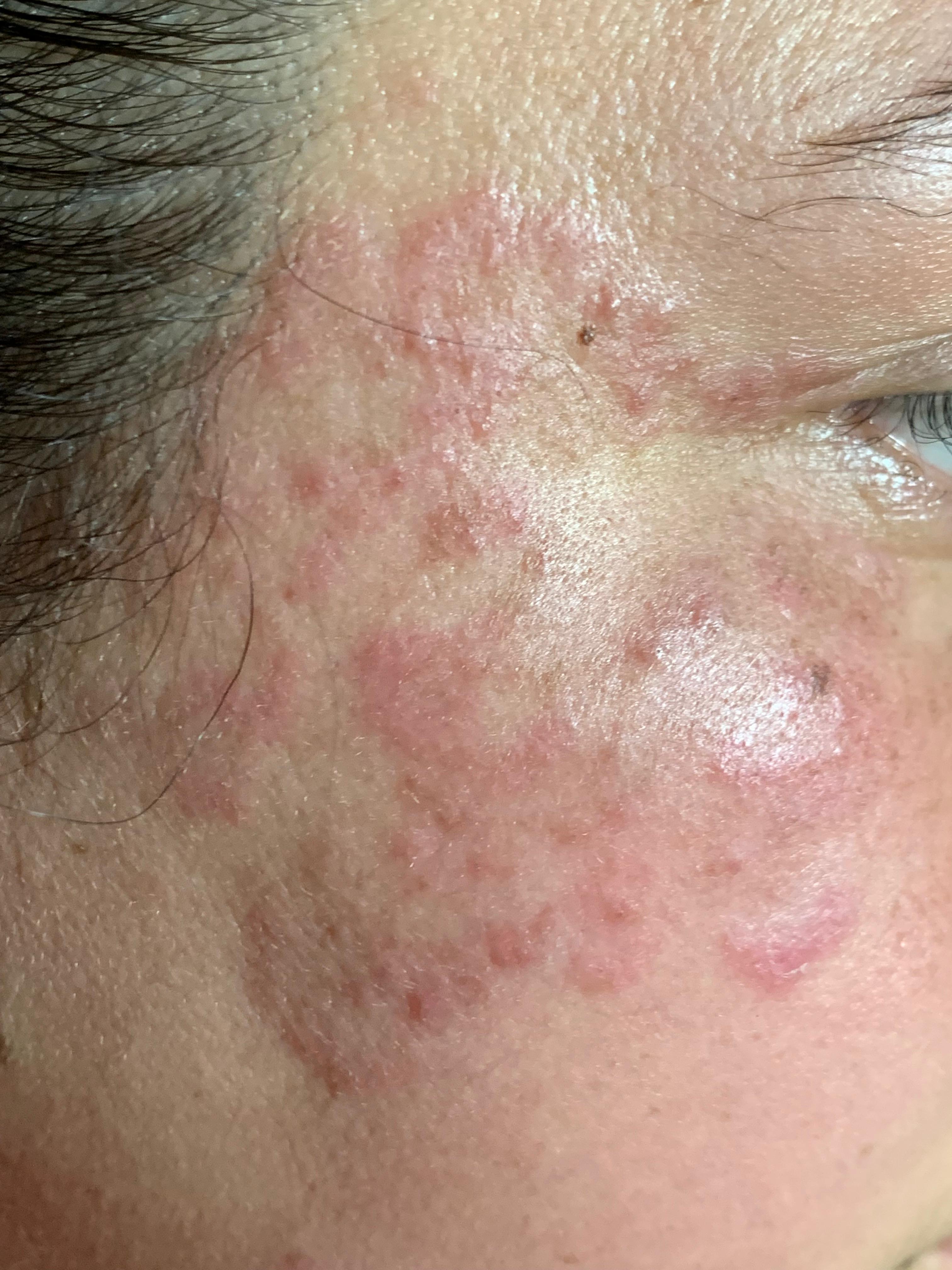 TINEA DE LA CARA