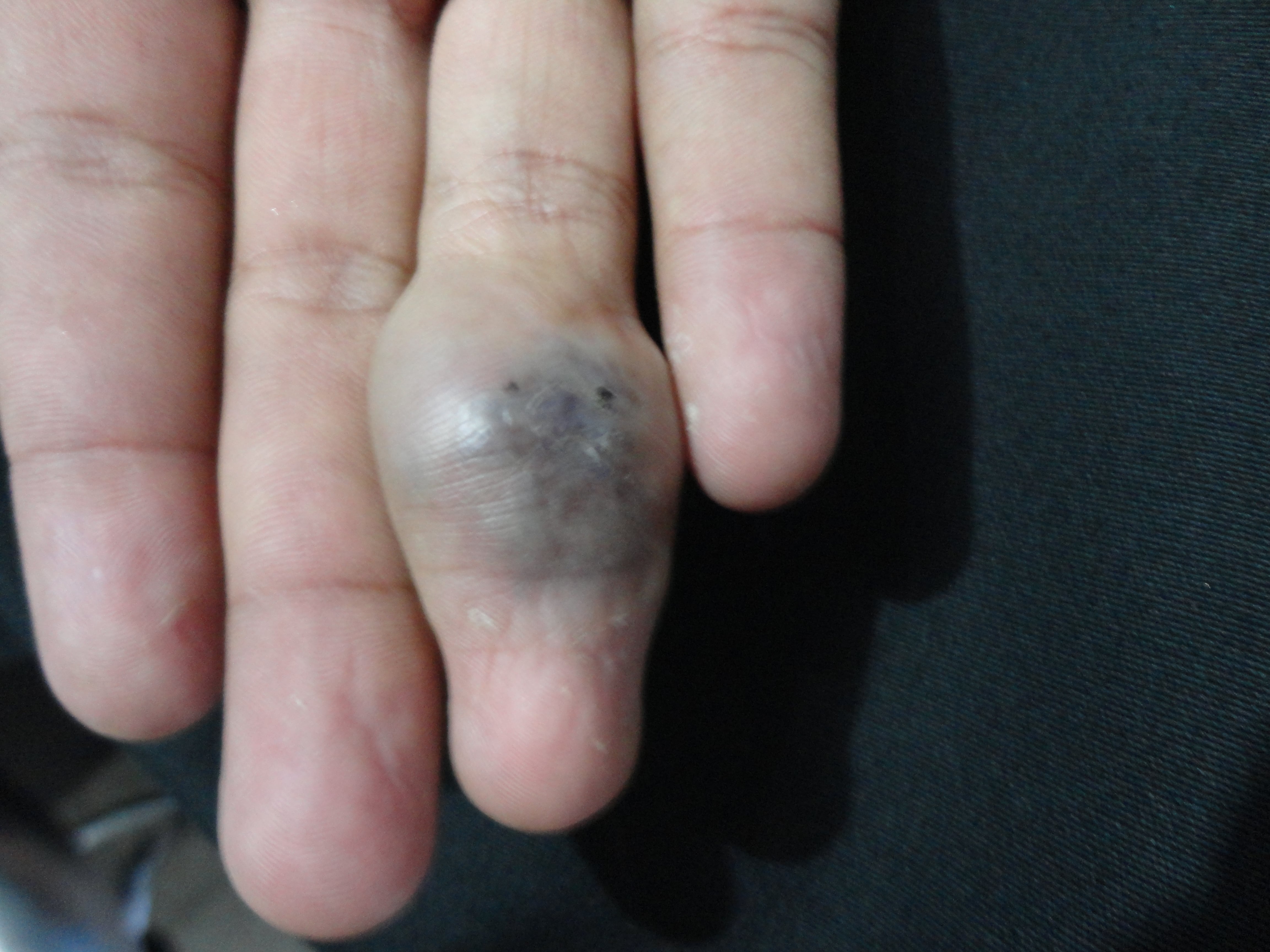 HEMANGIOMA CAVERNOSO