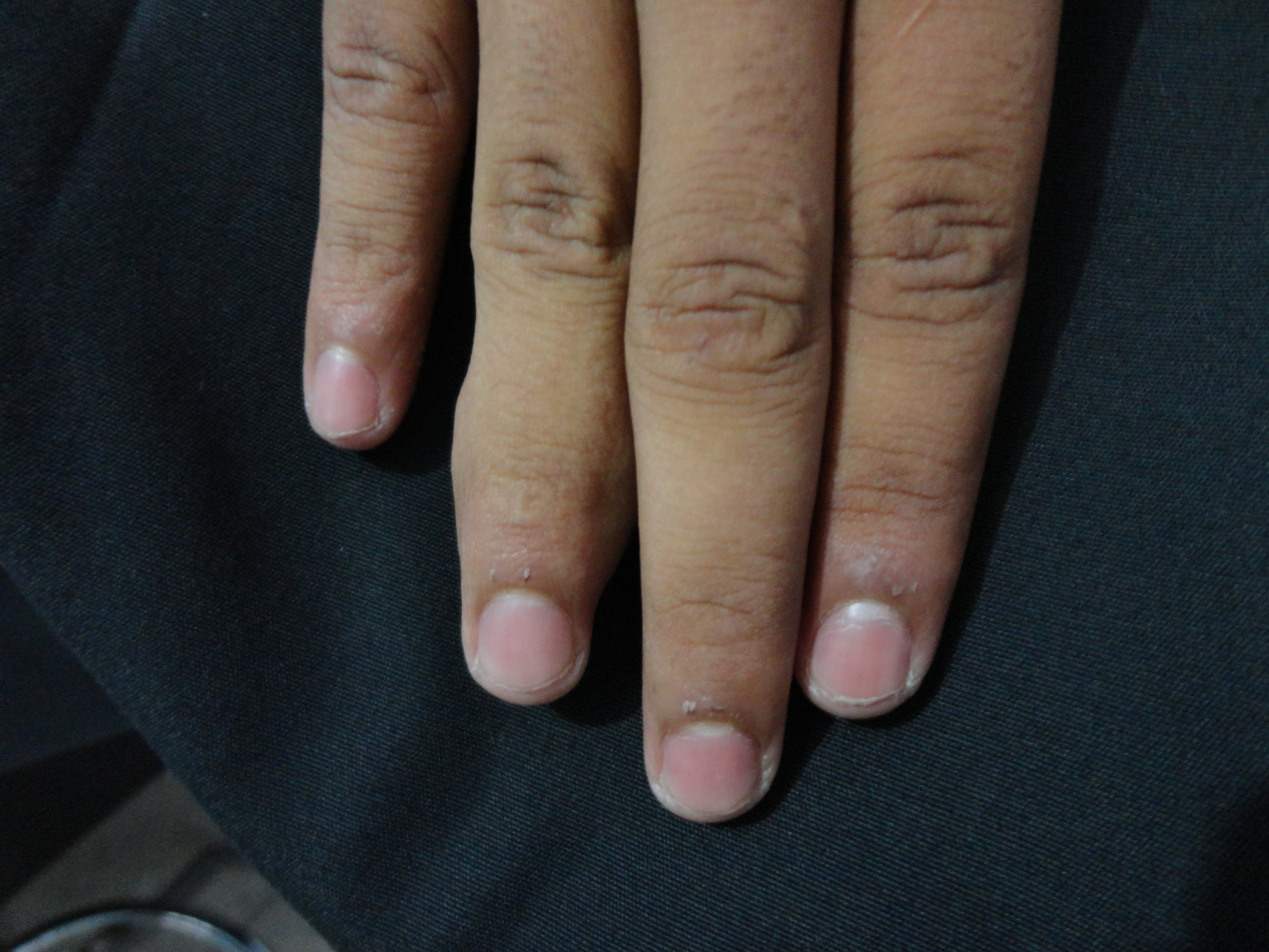 HEMANGIOMA CAVERNOSO