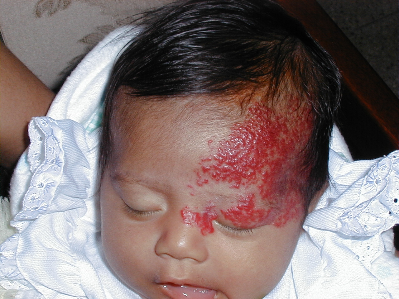 HEMANGIOMA FRESA EN CARA
