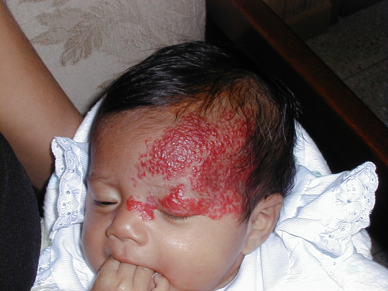 HEMANGIOMA FRESA EN CARA