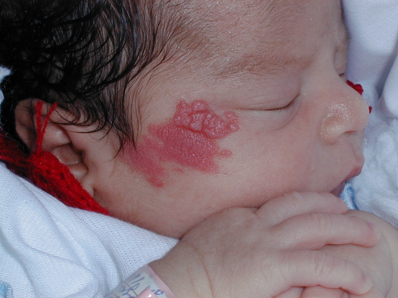 HEMANGIOMA FRESA EN CARA