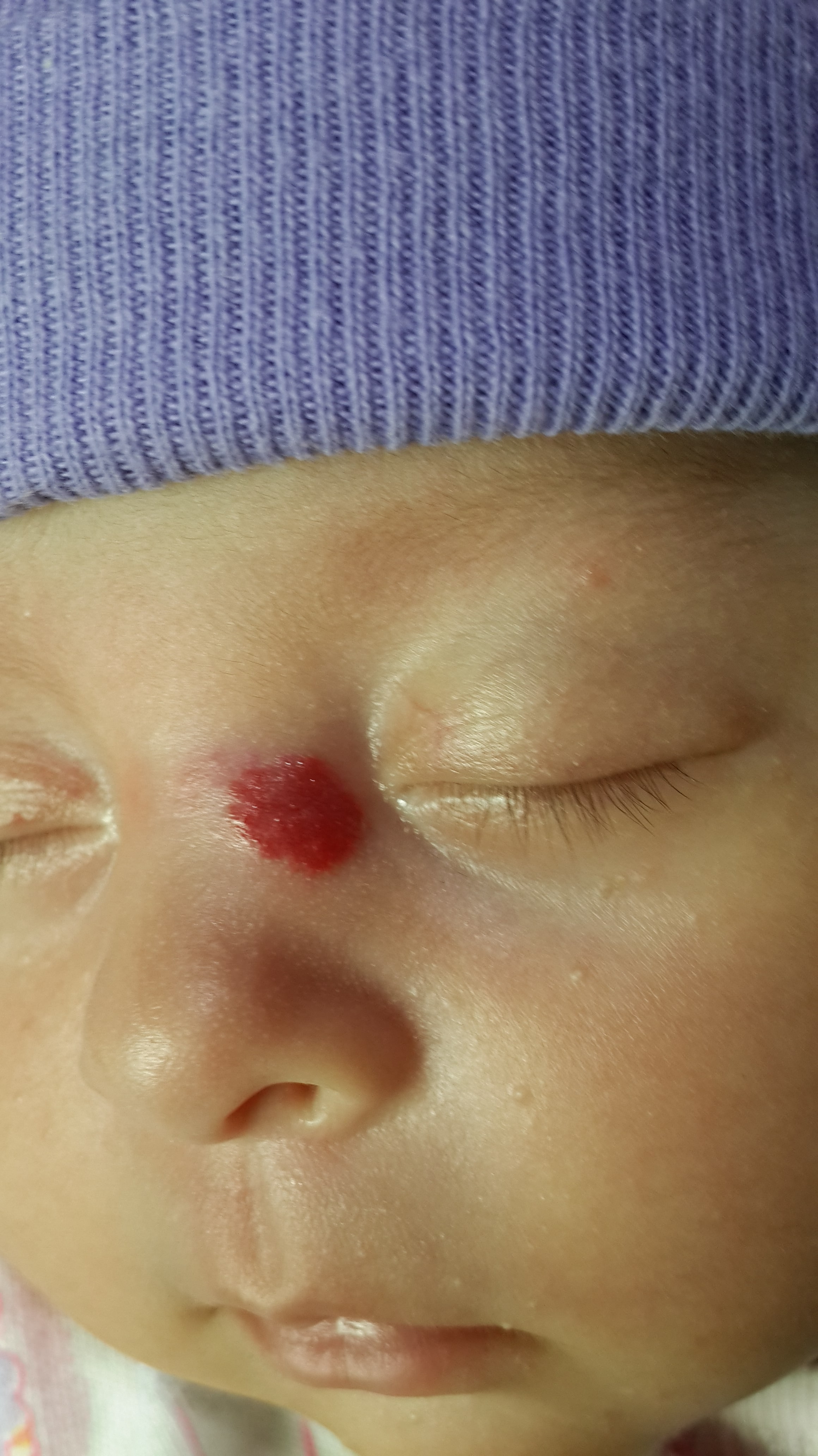 HEMANGIOMA FRESA EN CARA