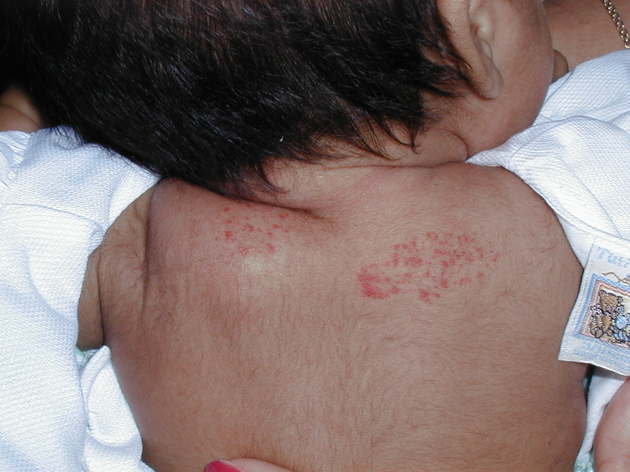 HEMANGIOMA FRESA