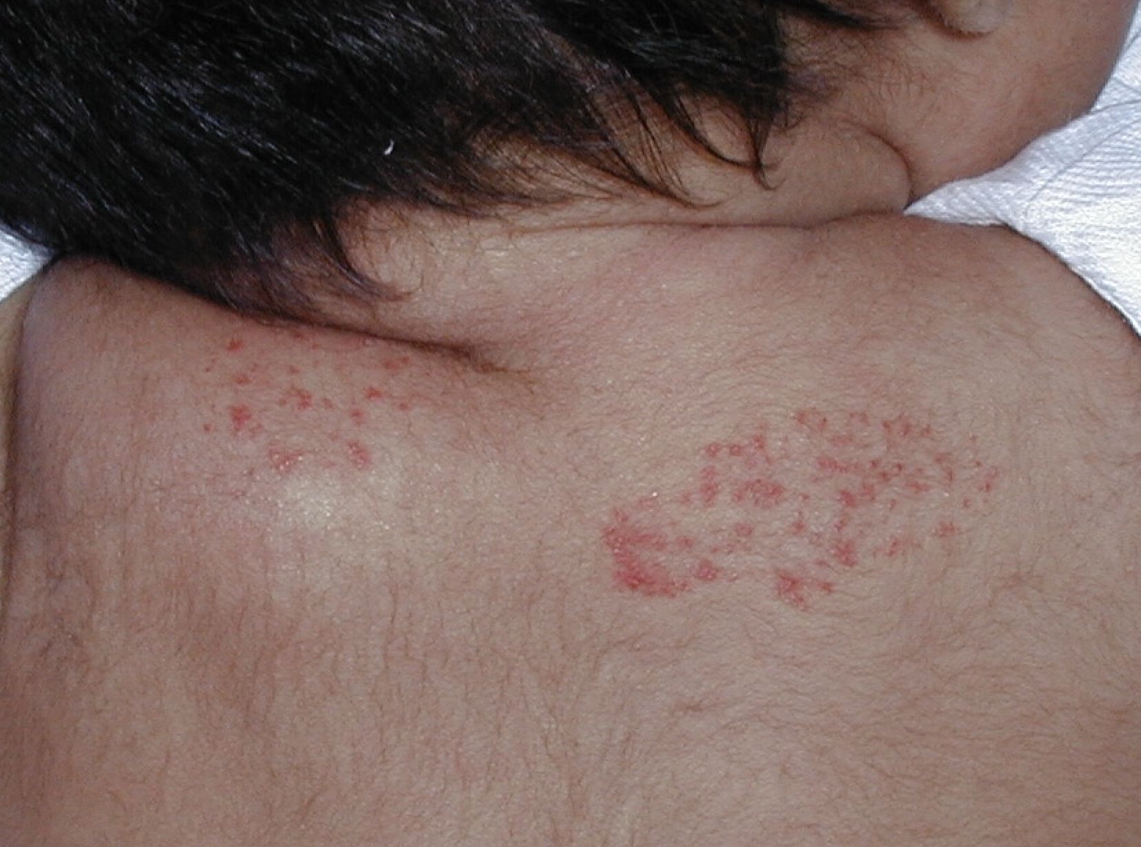 HEMANGIOMA FRESA