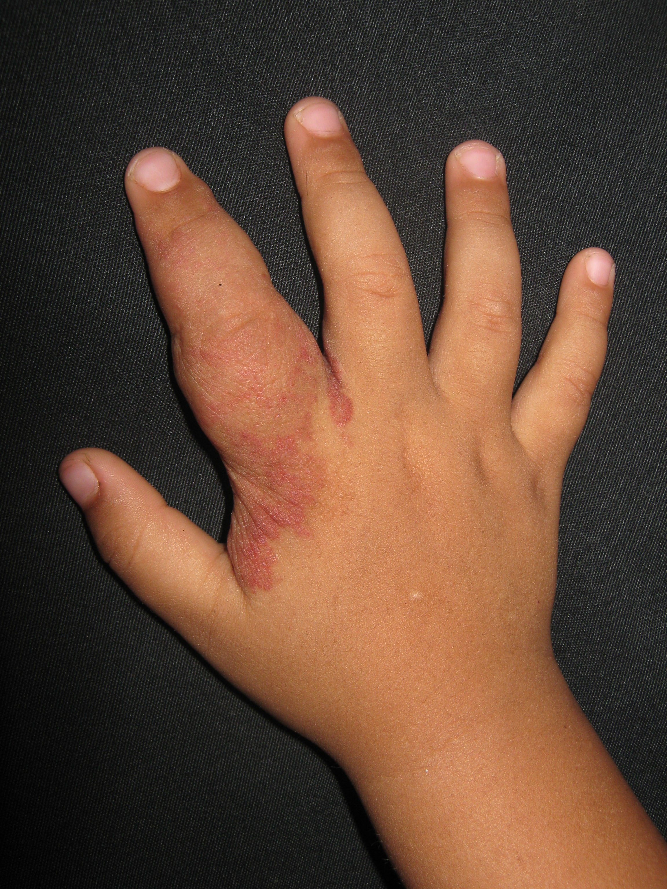 HEMANGIOMA FRESA en la mano
