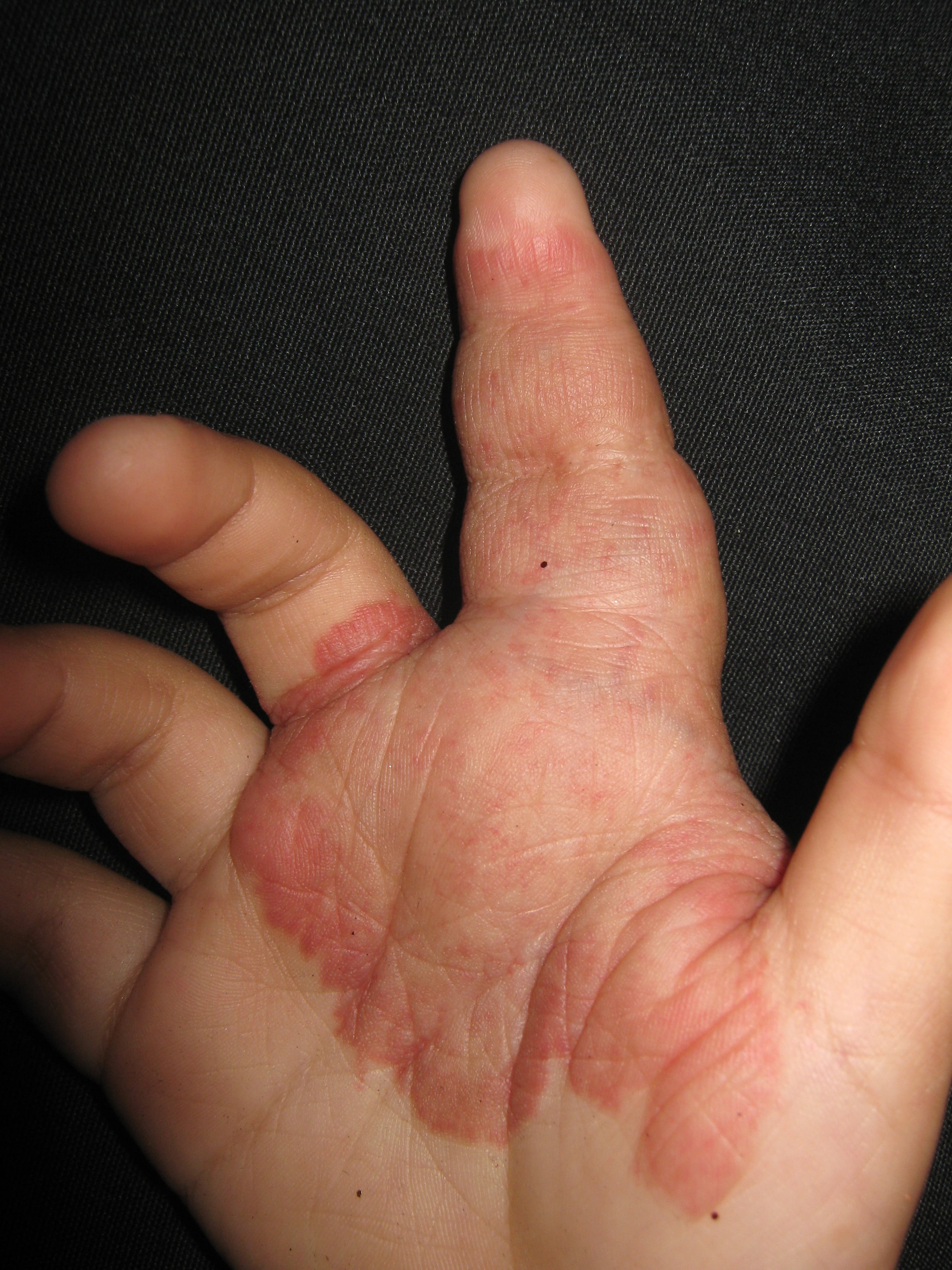HEMANGIOMA FRESA en la mano