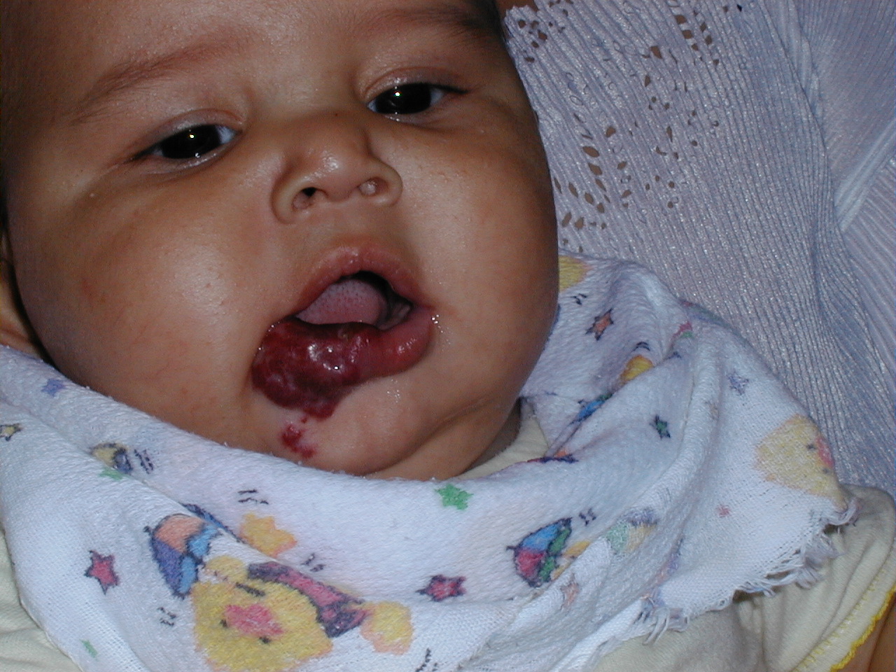 HEMANGIOMA FRESA - PROPANOLOL