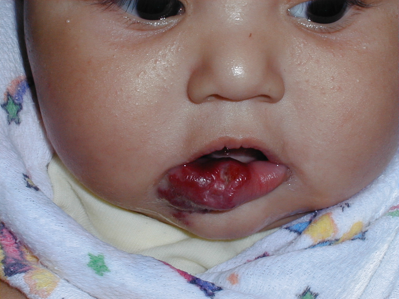 HEMANGIOMA FRESA - PROPANOLOL