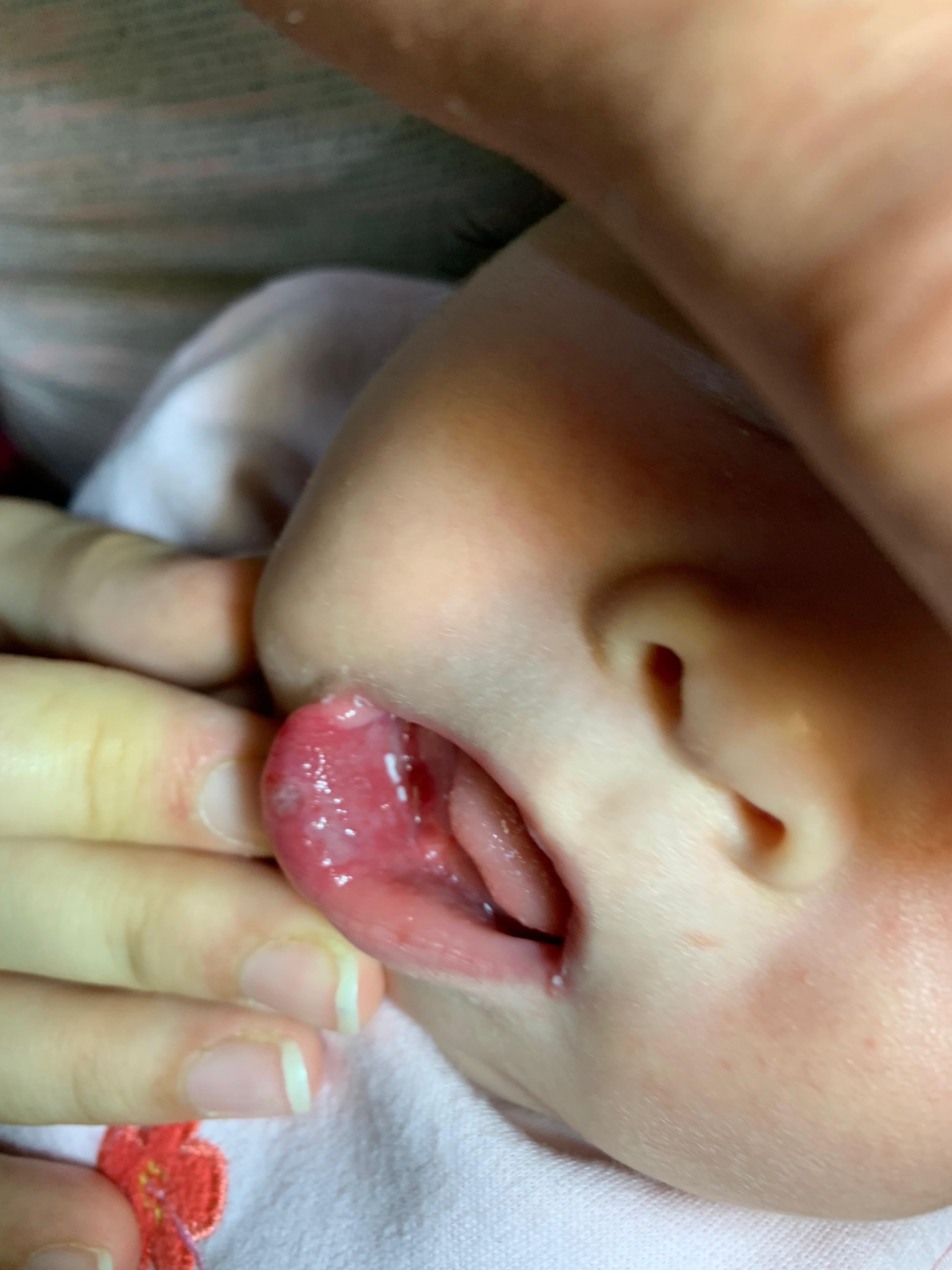 HEMANGIOMA FRESA - PROPANOLOL