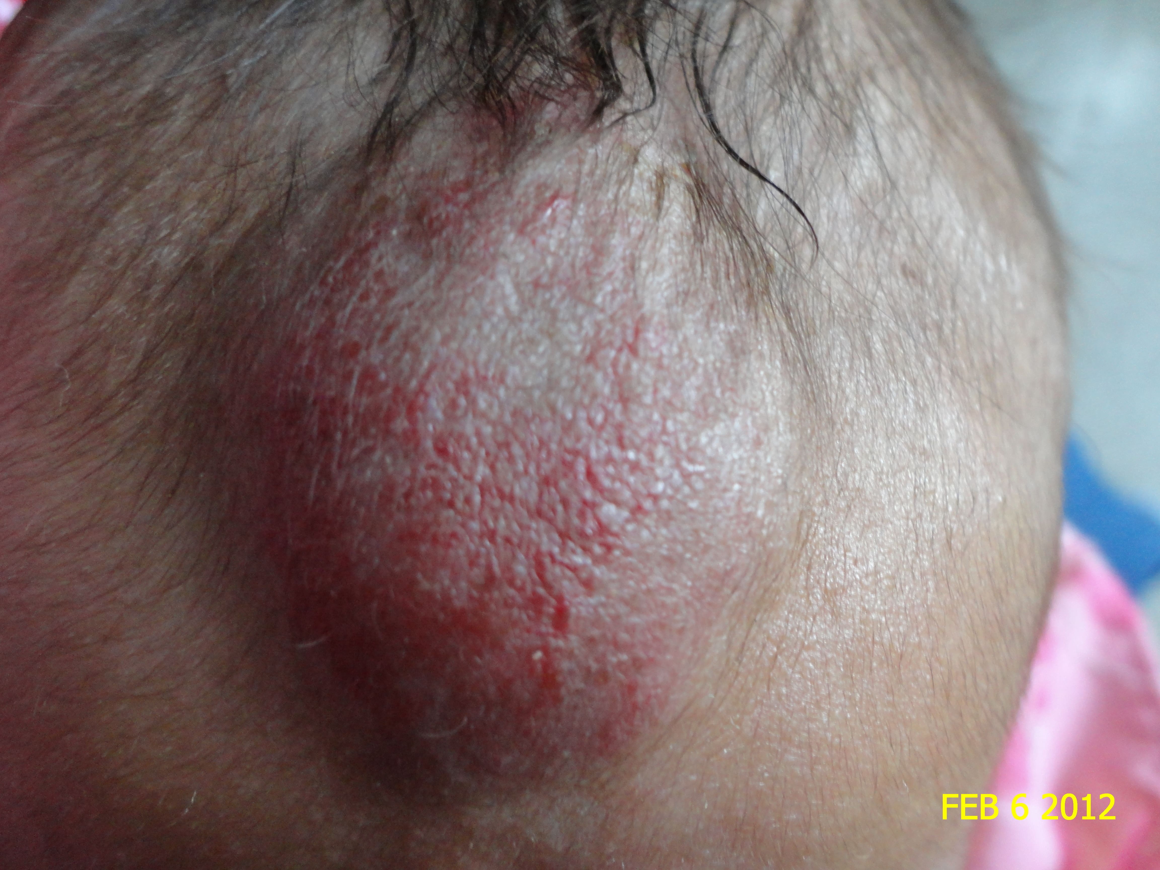 HEMANGIOMA FRESA - Propanolol