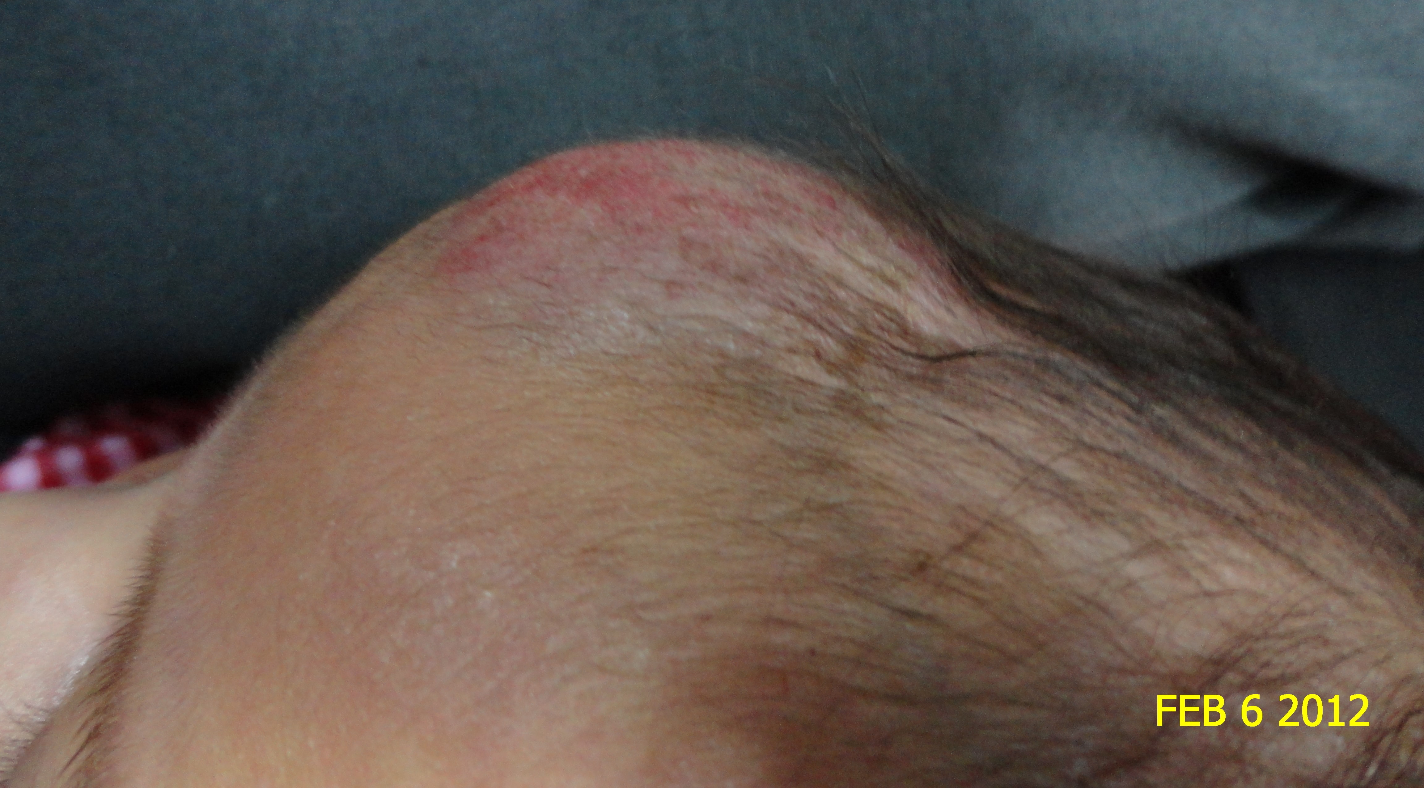 HEMANGIOMA FRESA - Propanolol