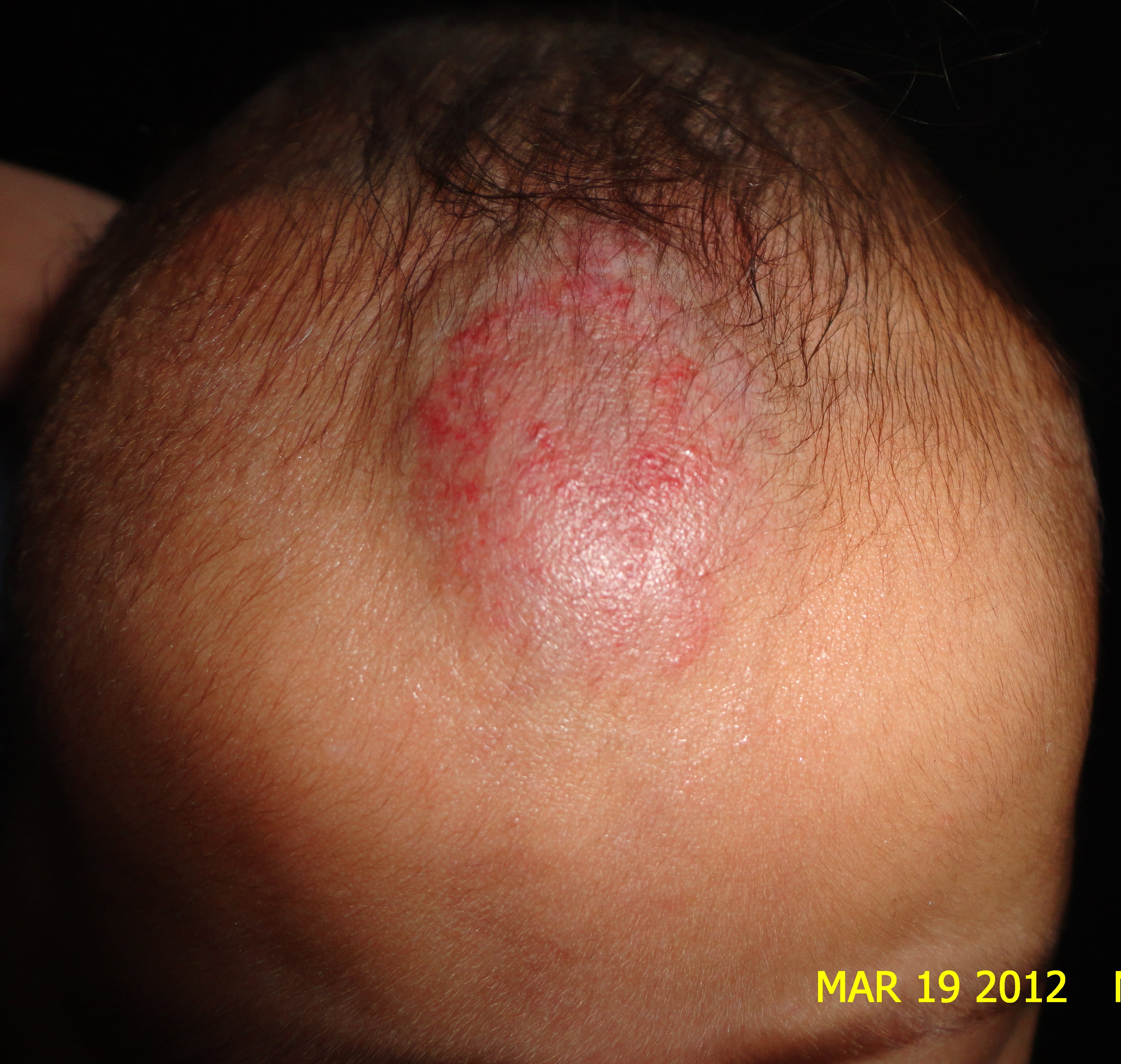 HEMANGIOMA FRESA - Propanolol