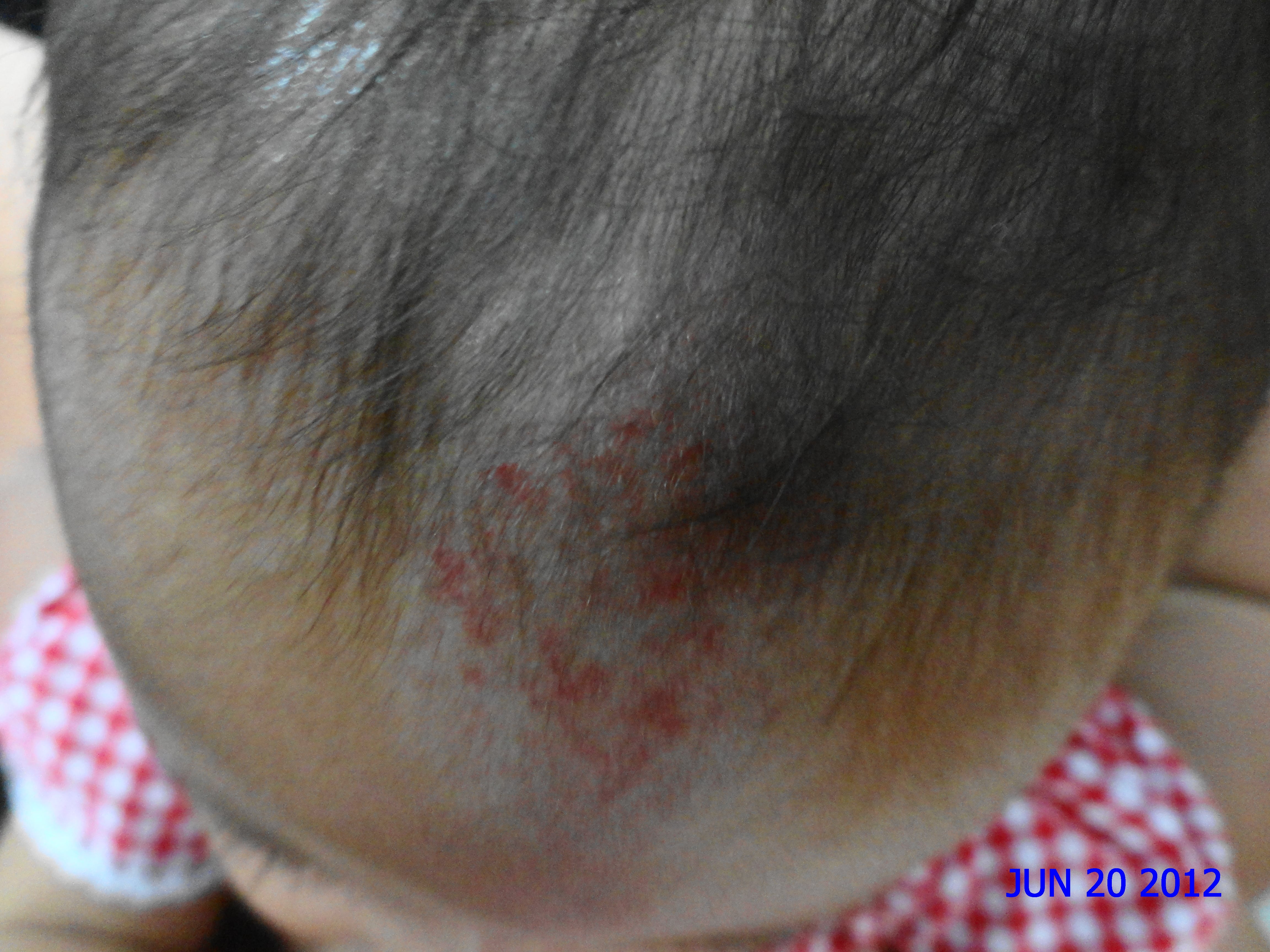 HEMANGIOMA FRESA - Propanolol