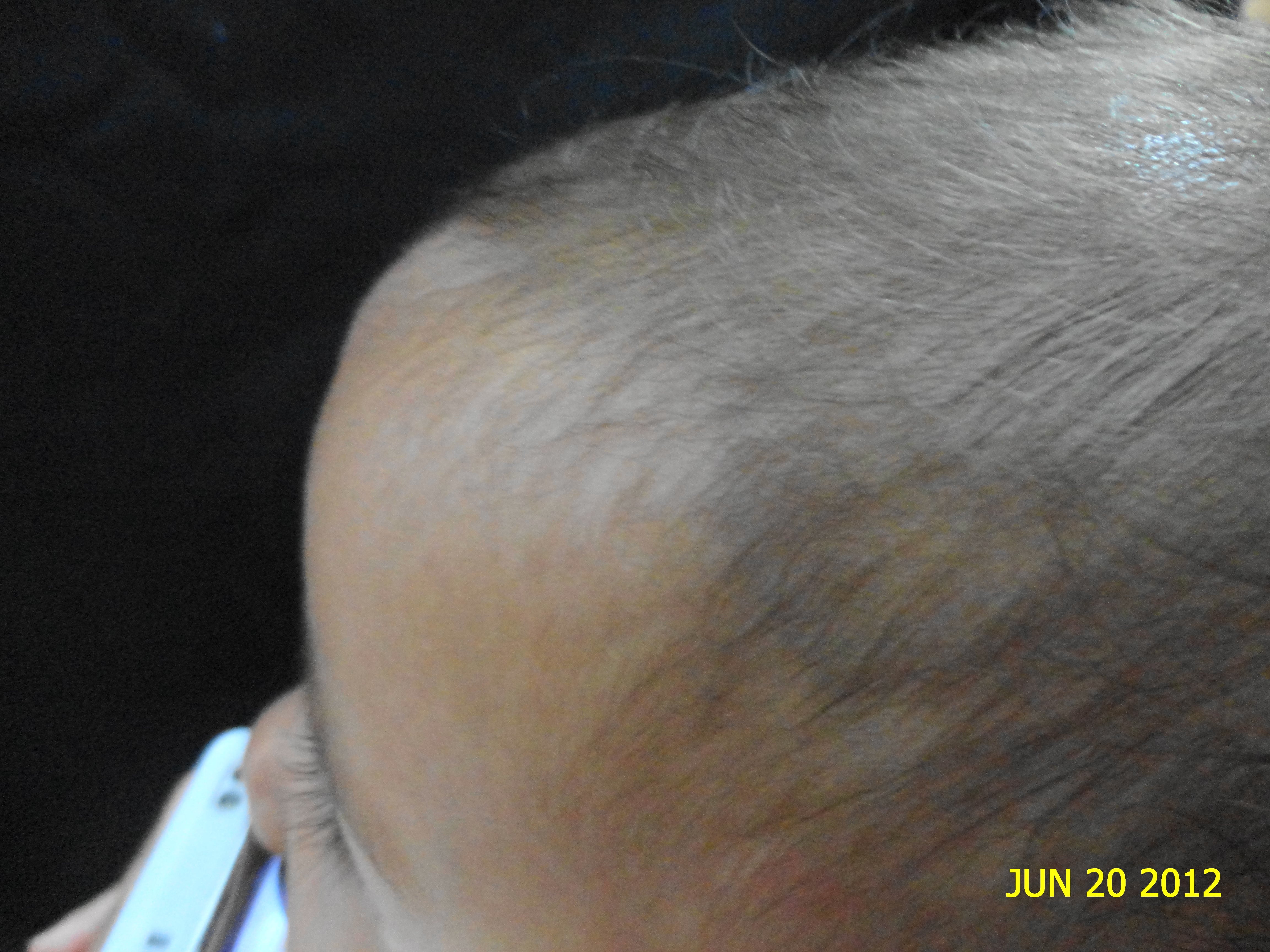 HEMANGIOMA FRESA - Propanolol