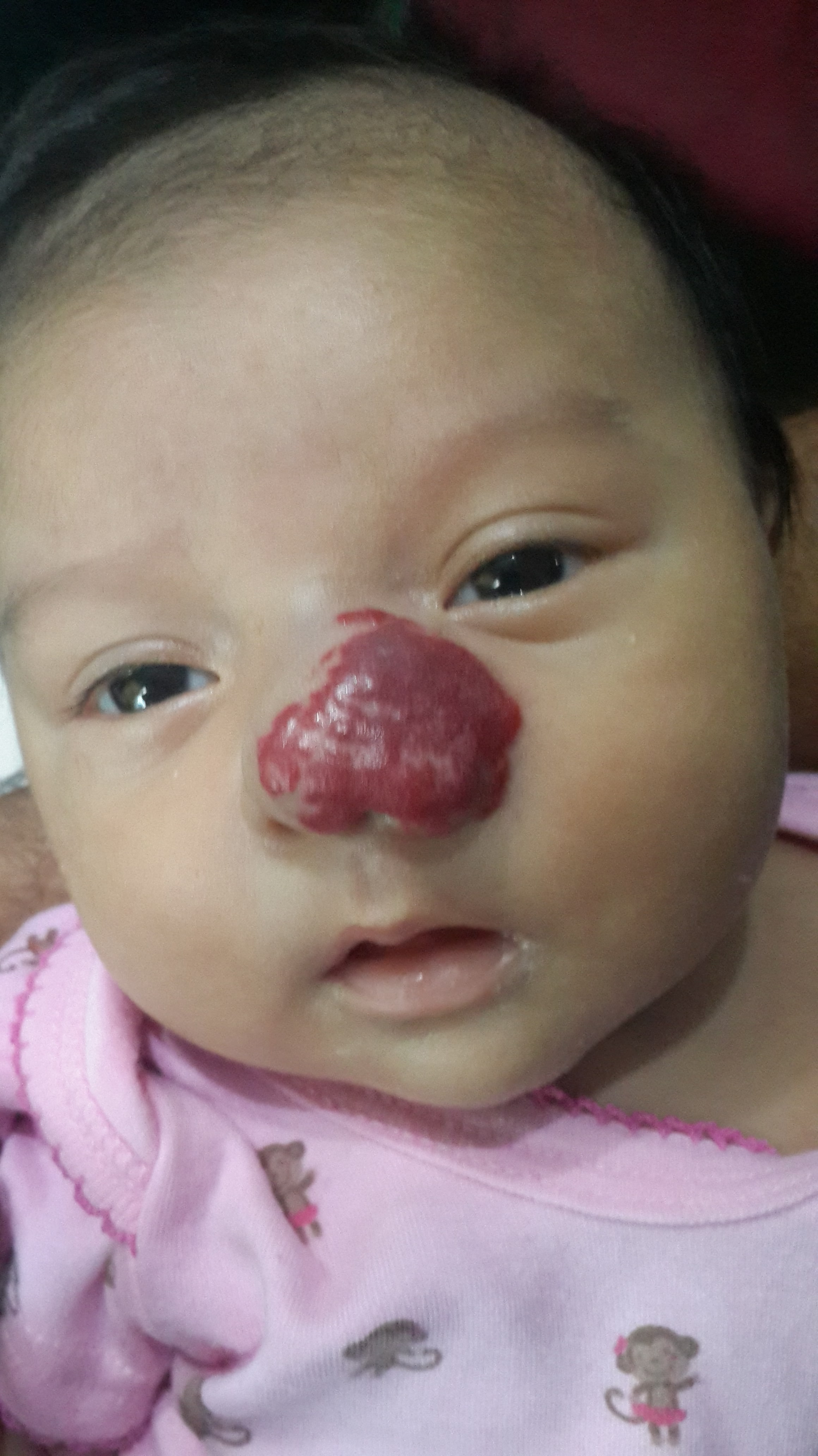 HEMANGIOMA FRESA - Propanolol