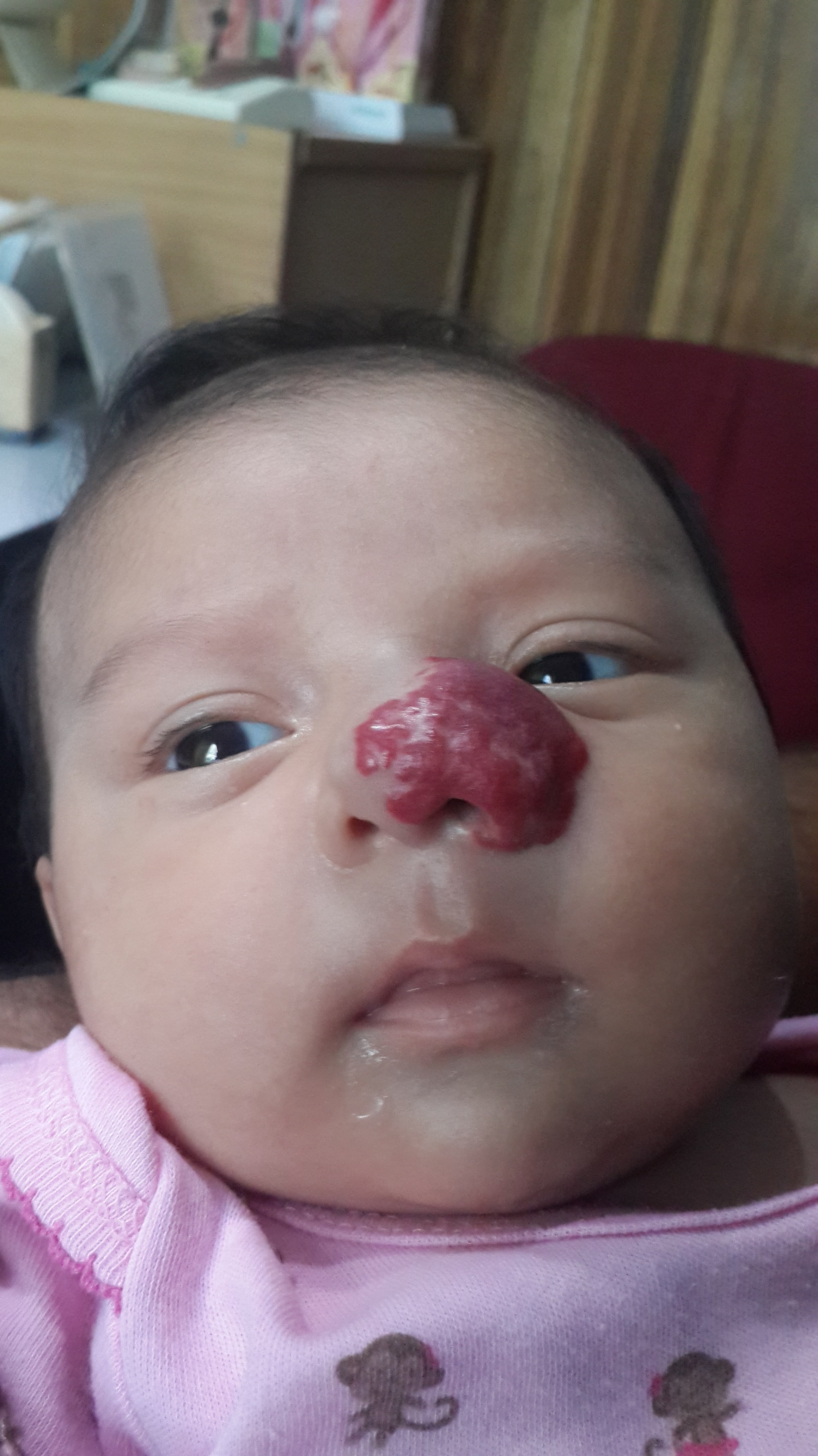 HEMANGIOMA FRESA - Propanolol