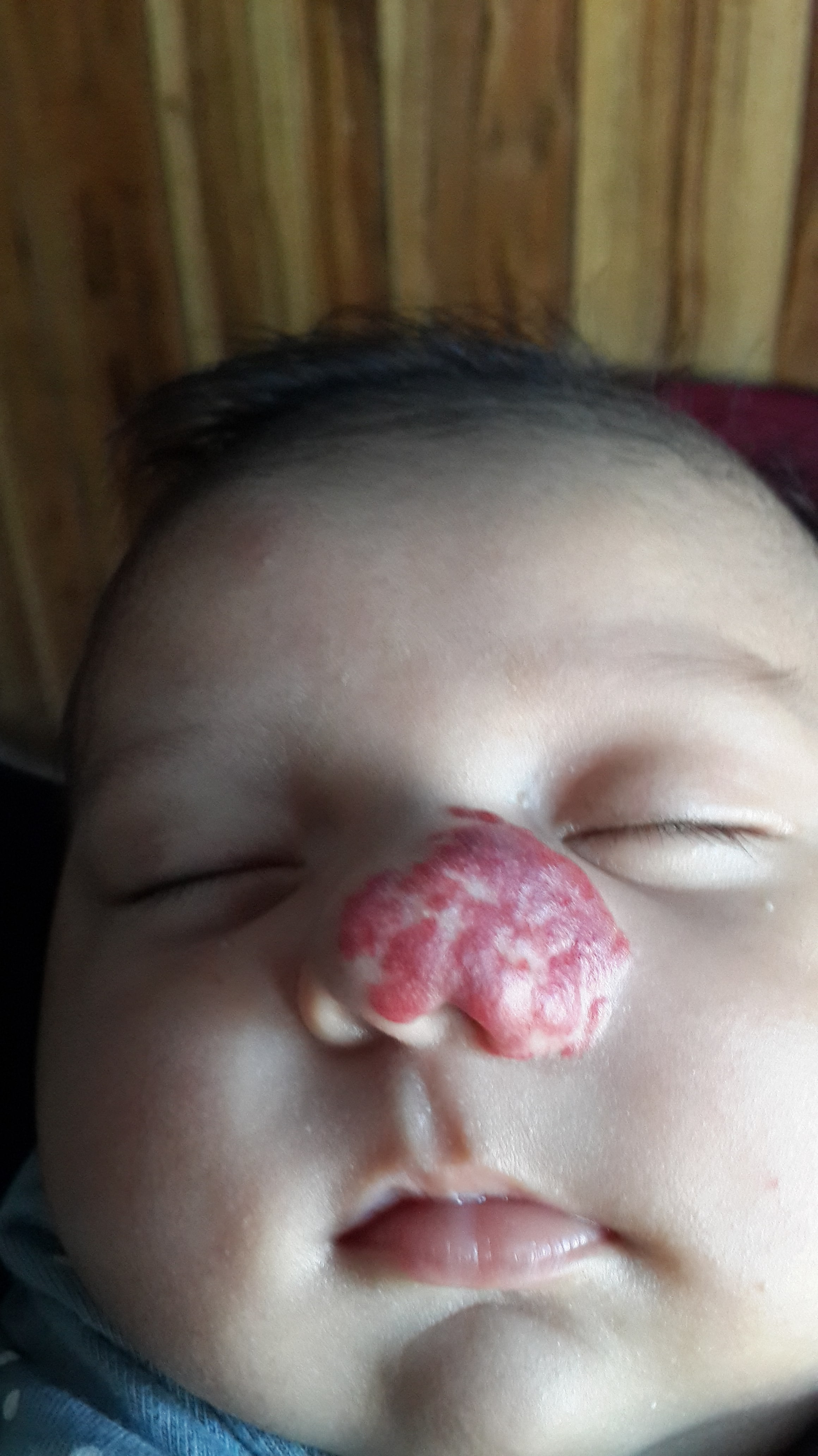 HEMANGIOMA FRESA - Propanolol