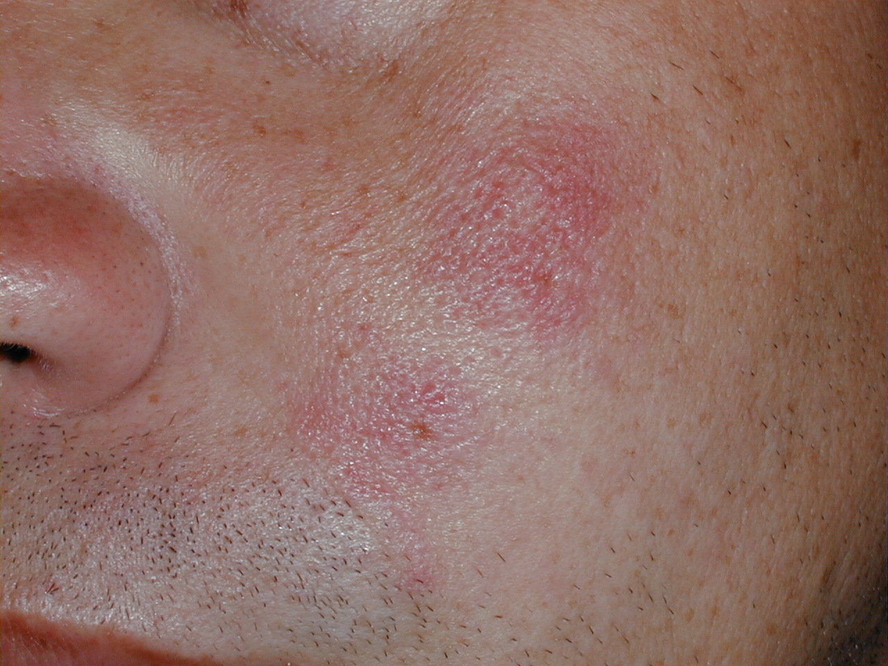 HEMANGIOMA PLANO en cara