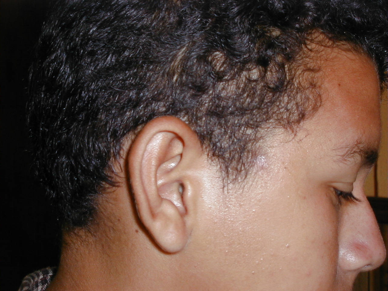 GRANULOMA PIOGENO - Curación