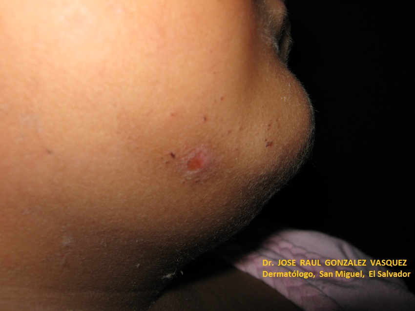 GRANULOMA PIOGENO  - Curación