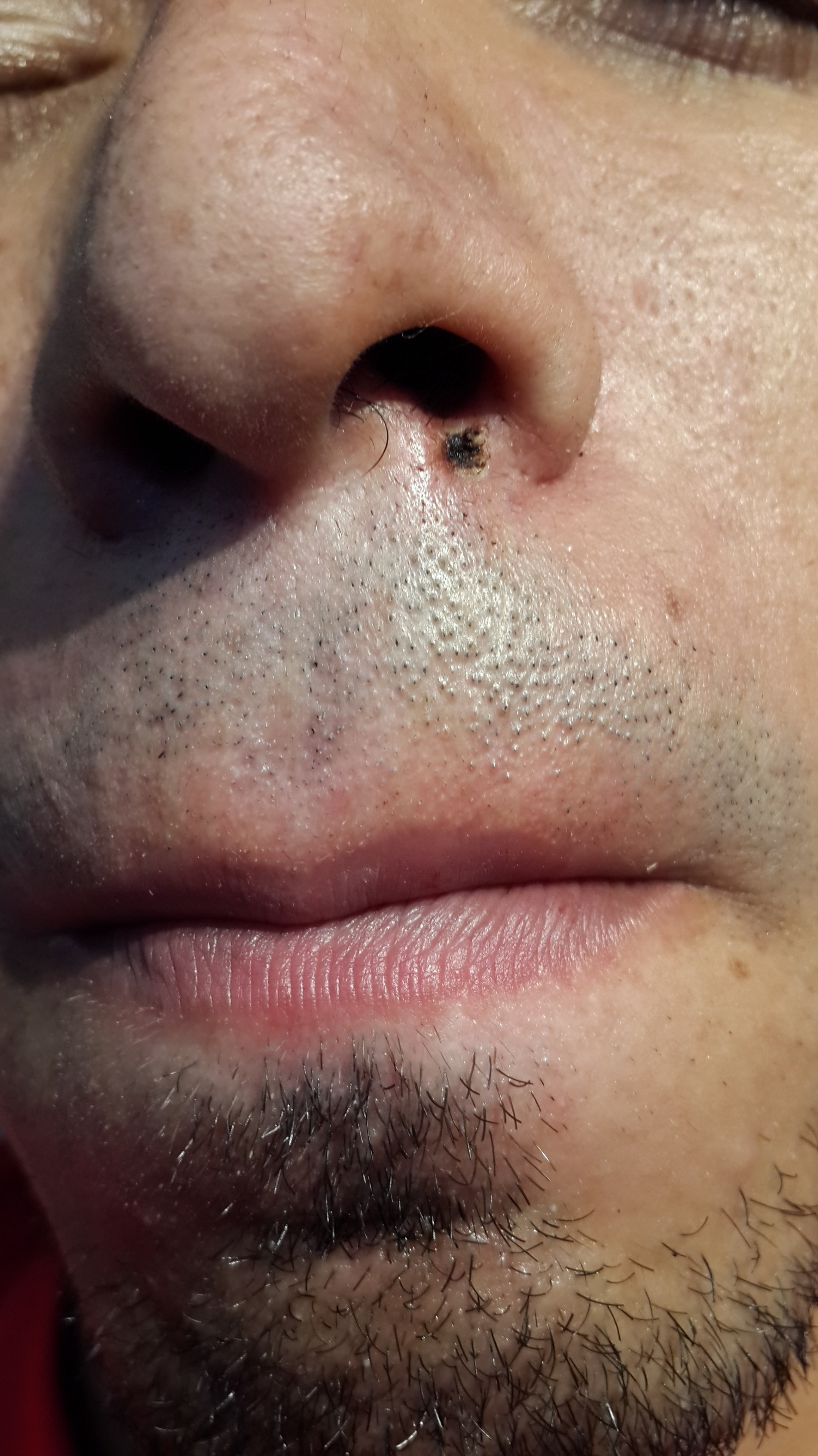 GRANULOMA PIOGENO  - Curación