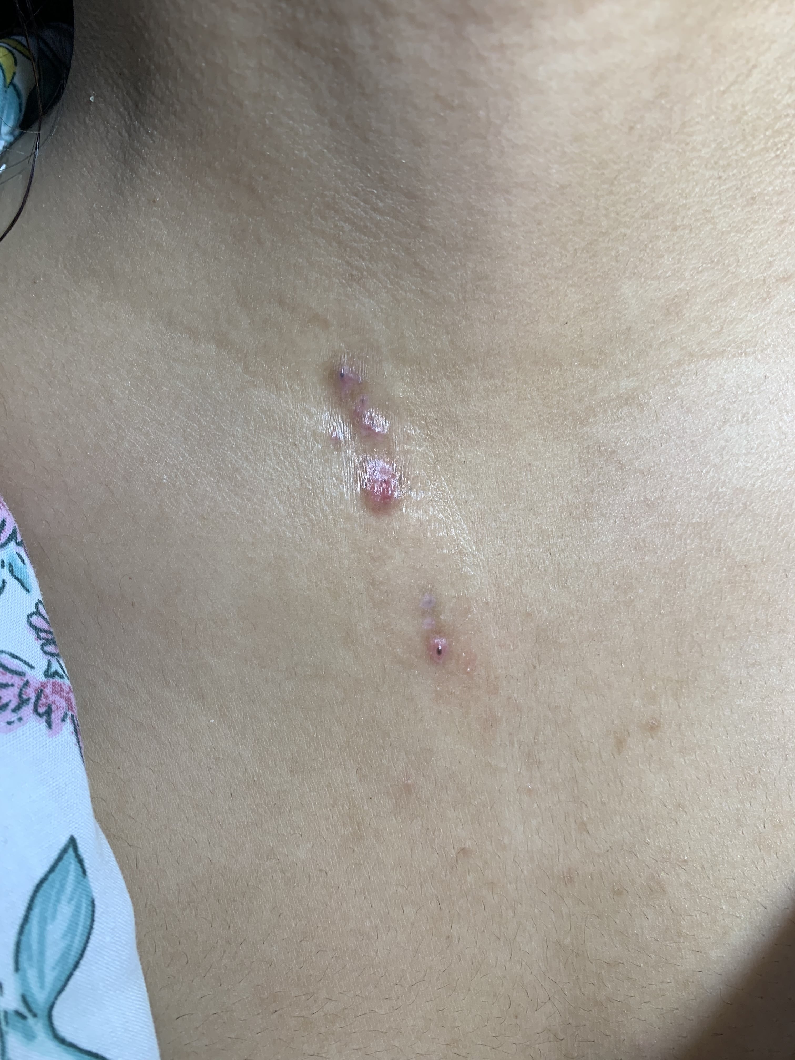 HIDRADENOMA PAPILIFERO