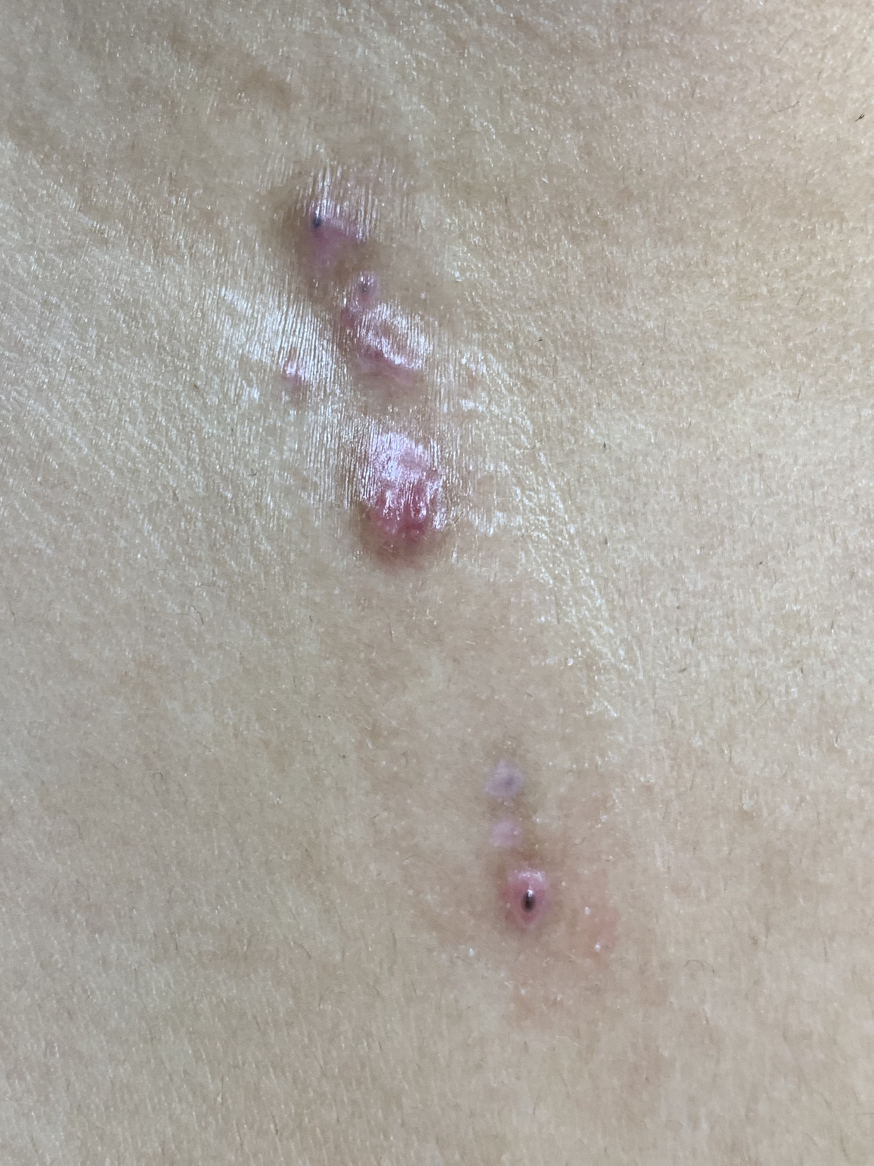 HIDRADENOMA PAPILIFERO