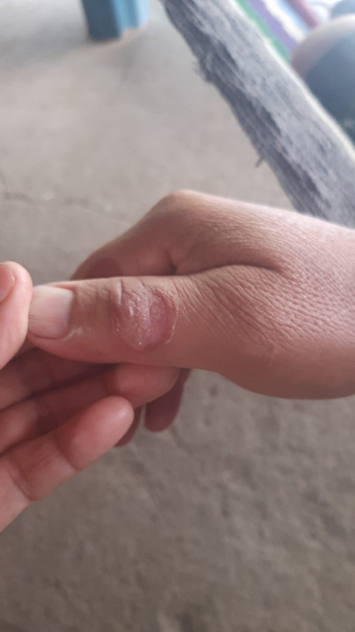 NODULO DE LOS ORDEÑADORES