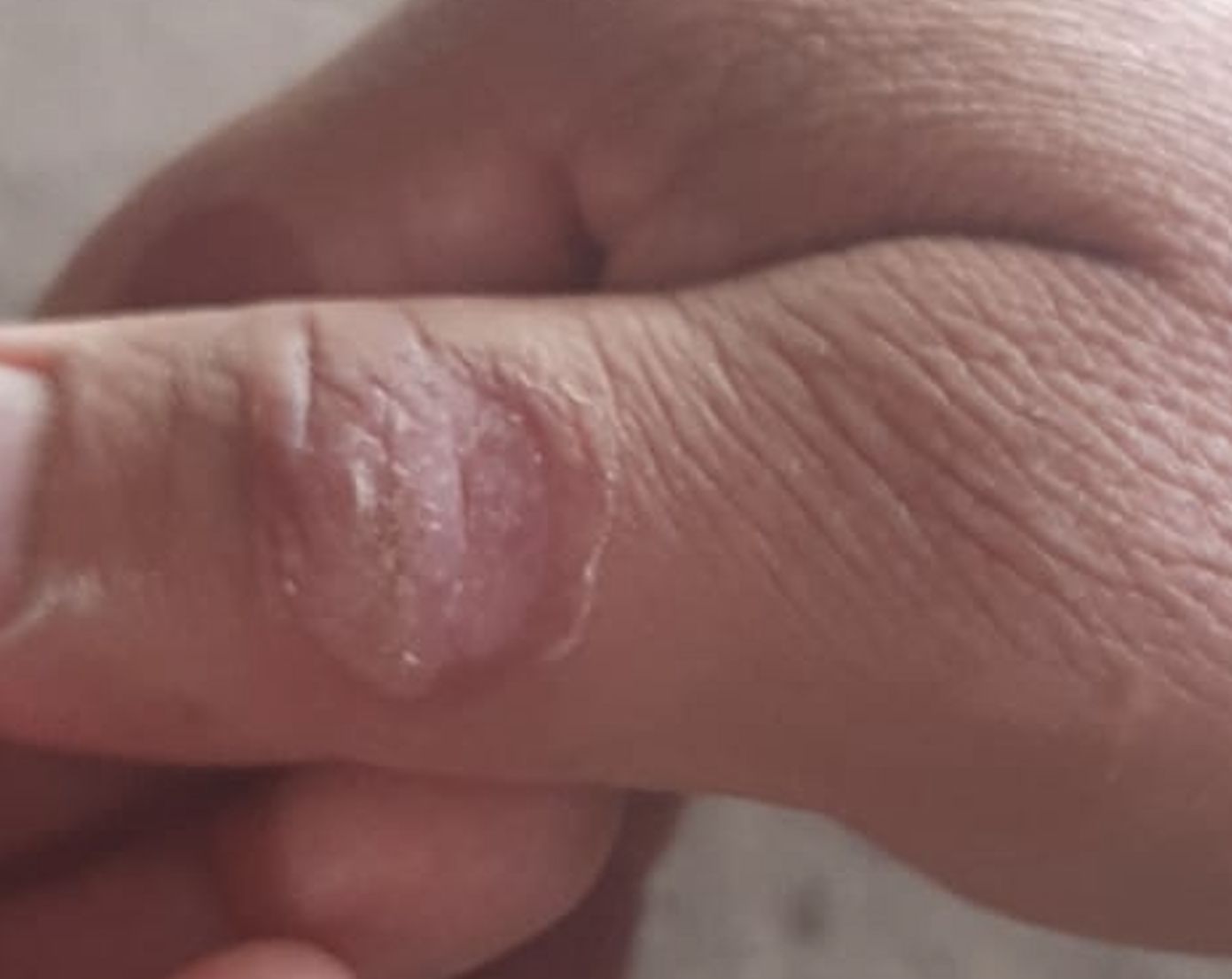 NODULO DE LOS ORDEÑADORES