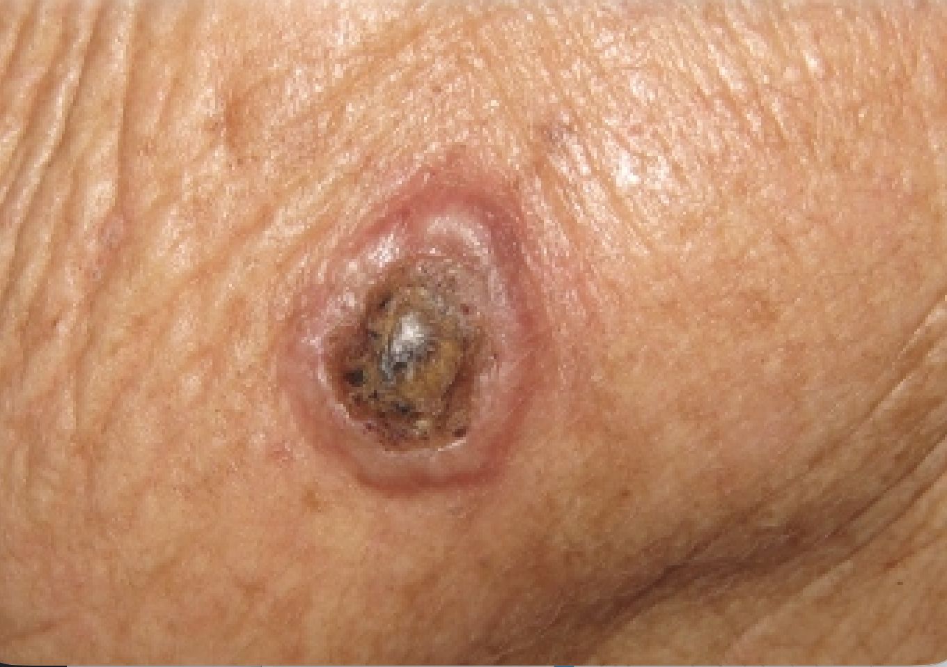 QUERATOACANTOMA