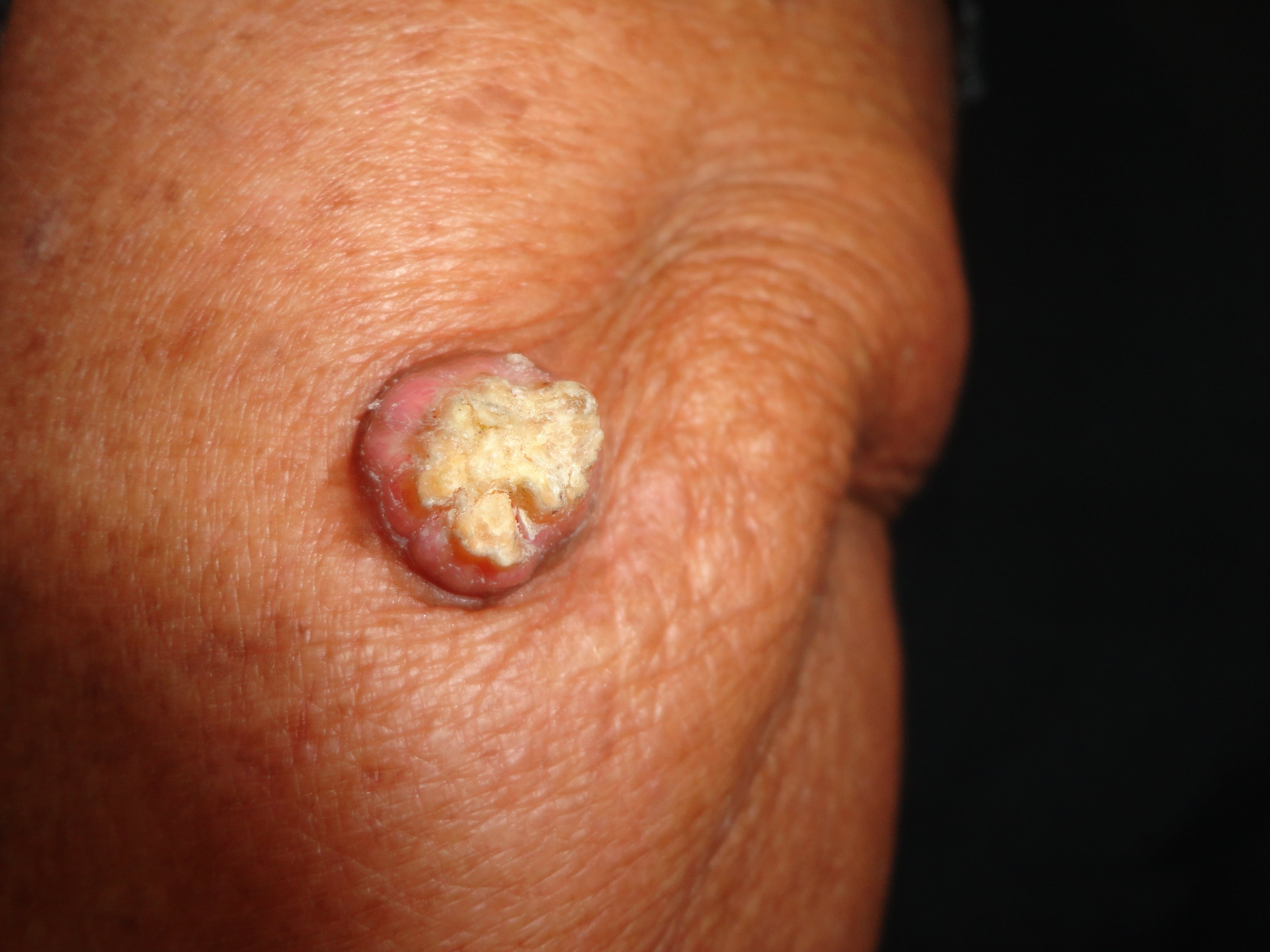 QUERATOACANTOMA