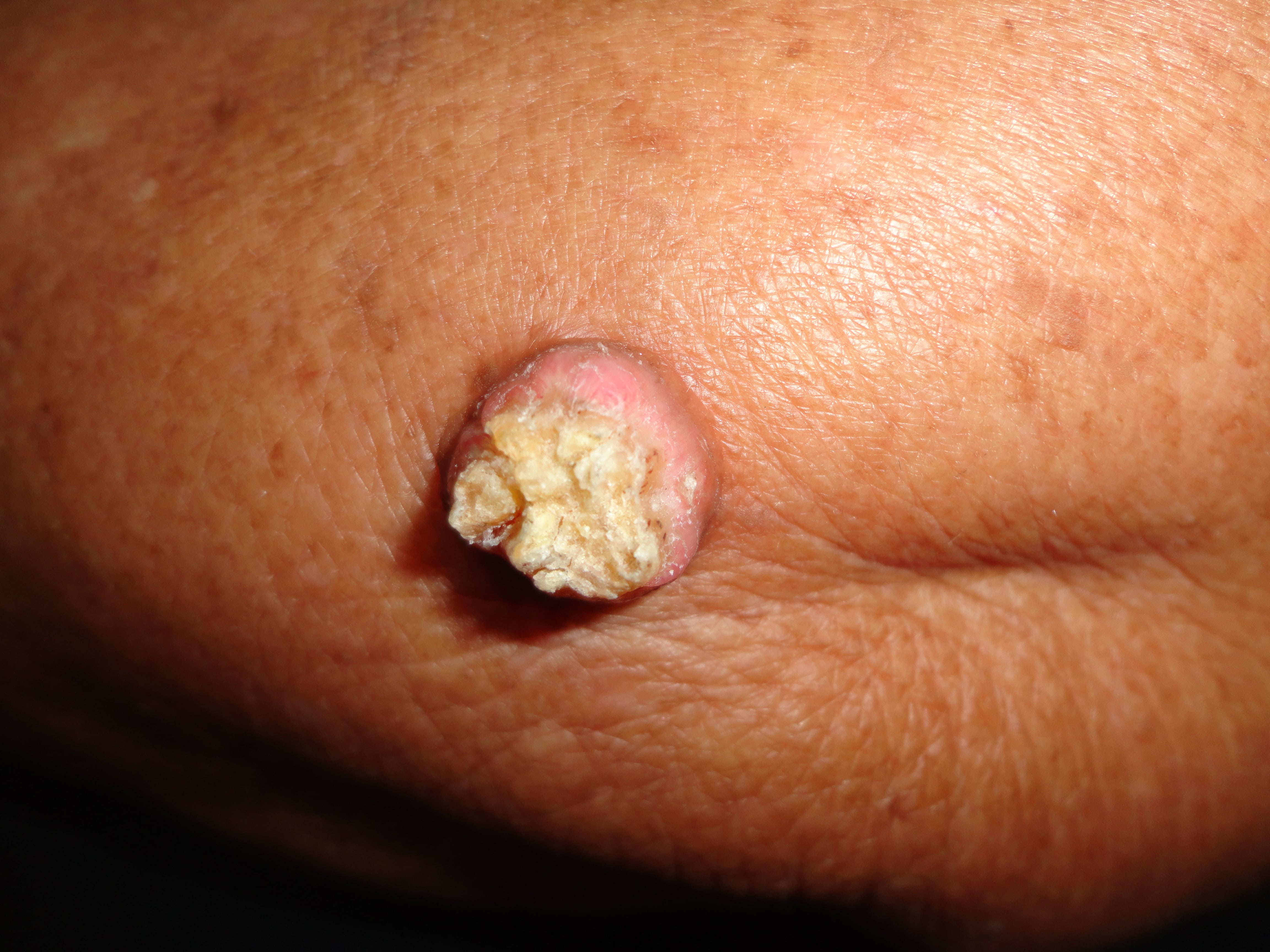 QUERATOACANTOMA
