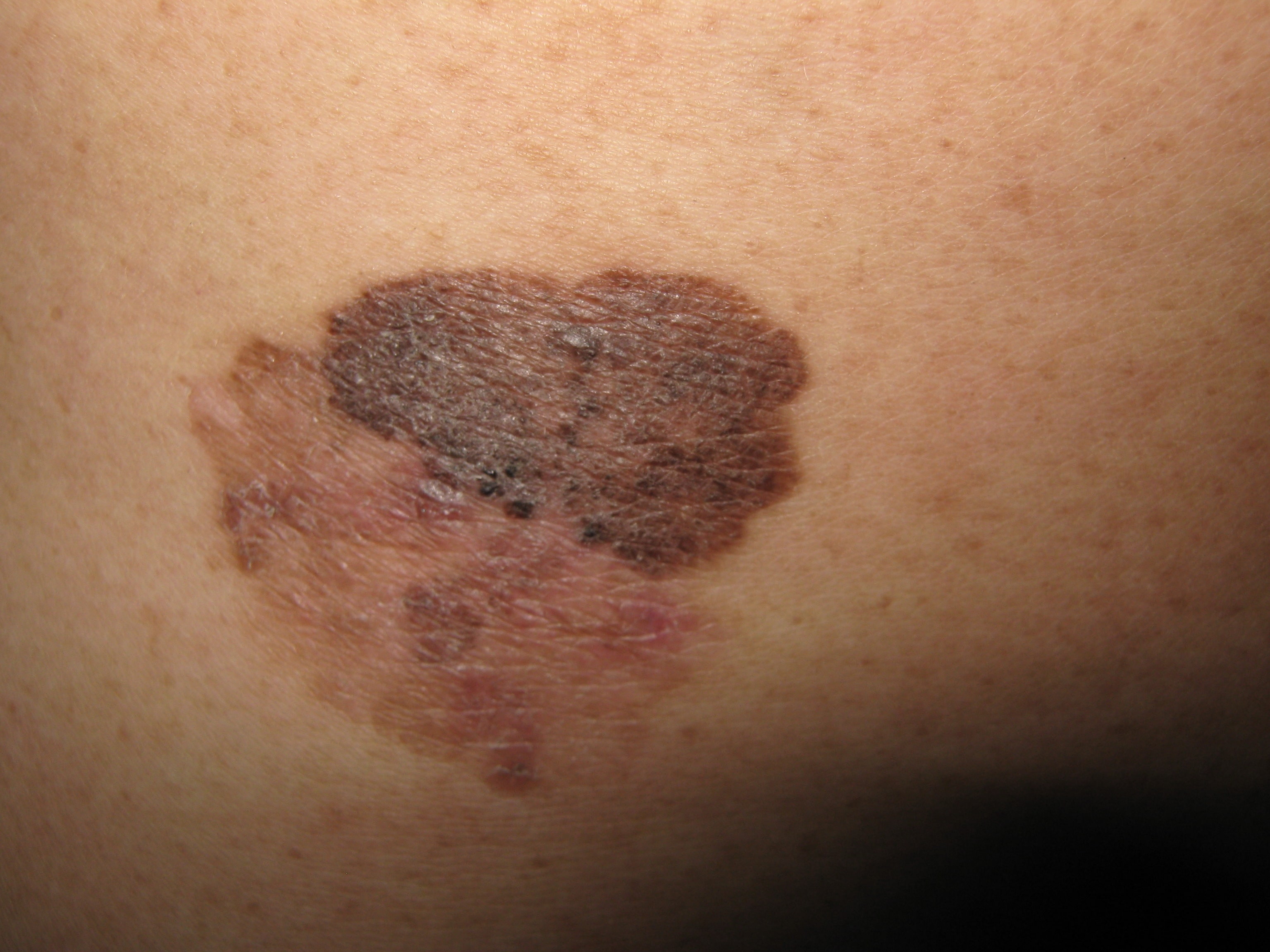 QUERATOSIS SEBORREICA