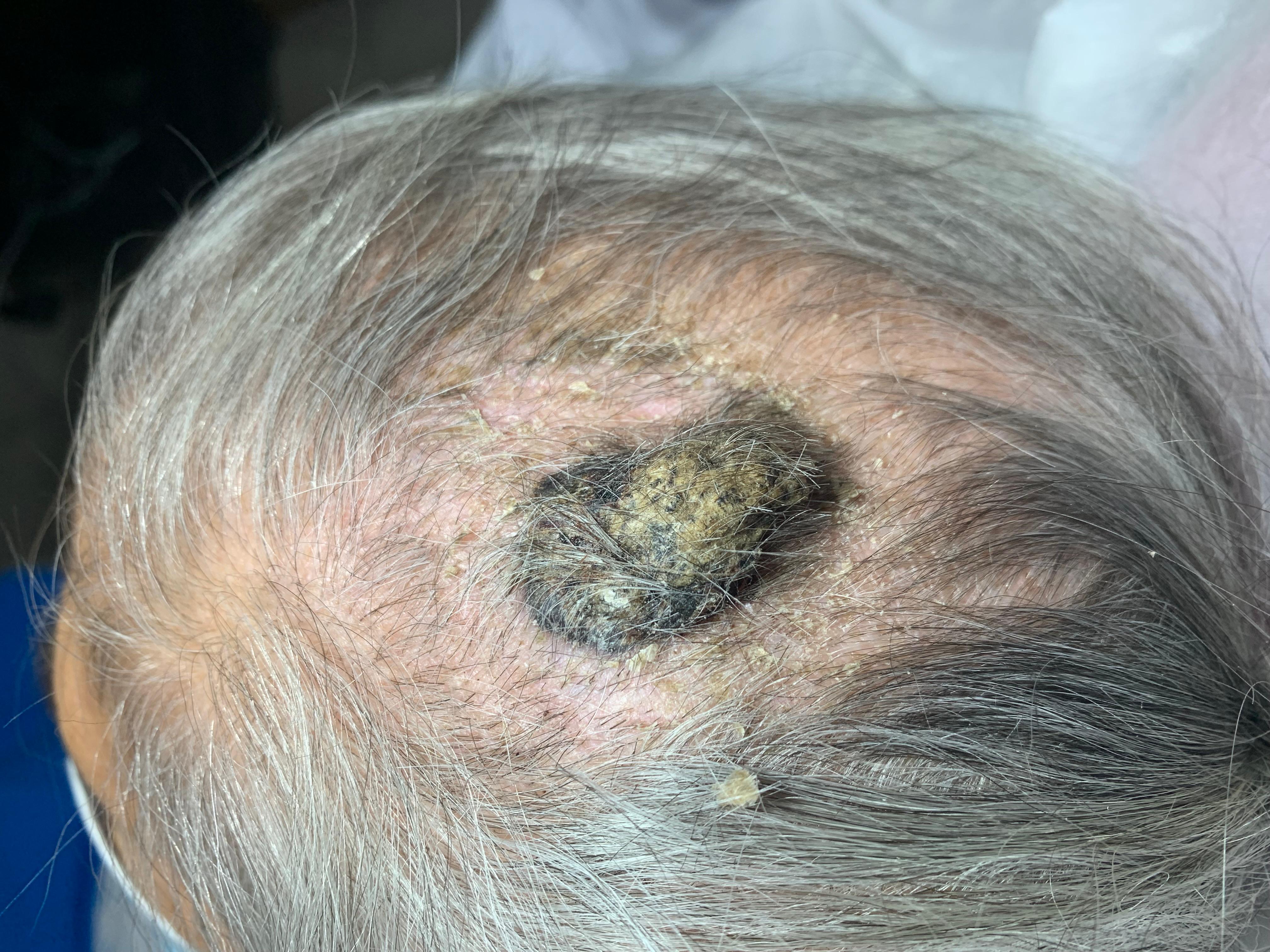 QUERATOSIS SEBORREICA